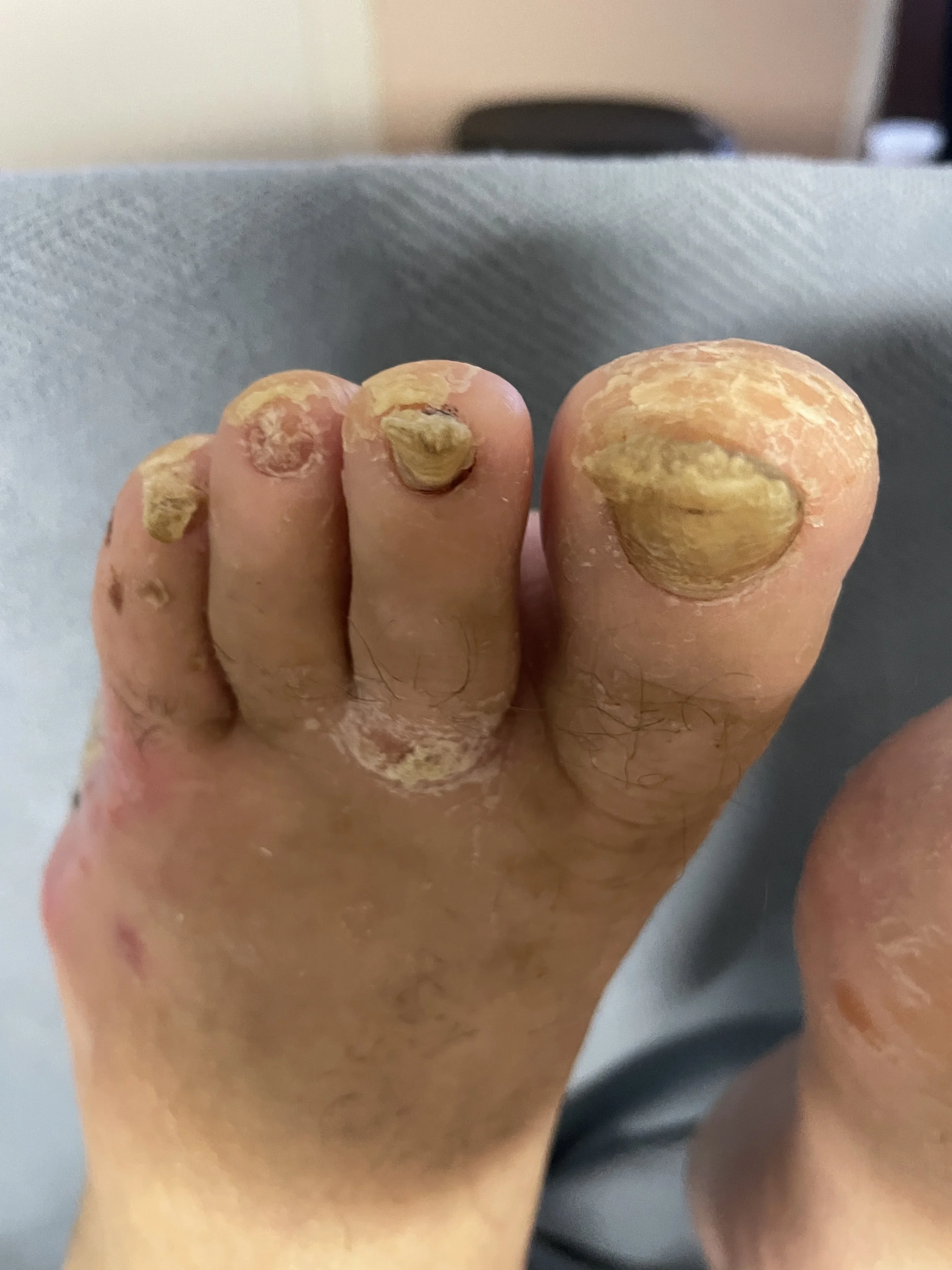 Close-up of toes with thick, yellowish, cracked, and peeling toenails.