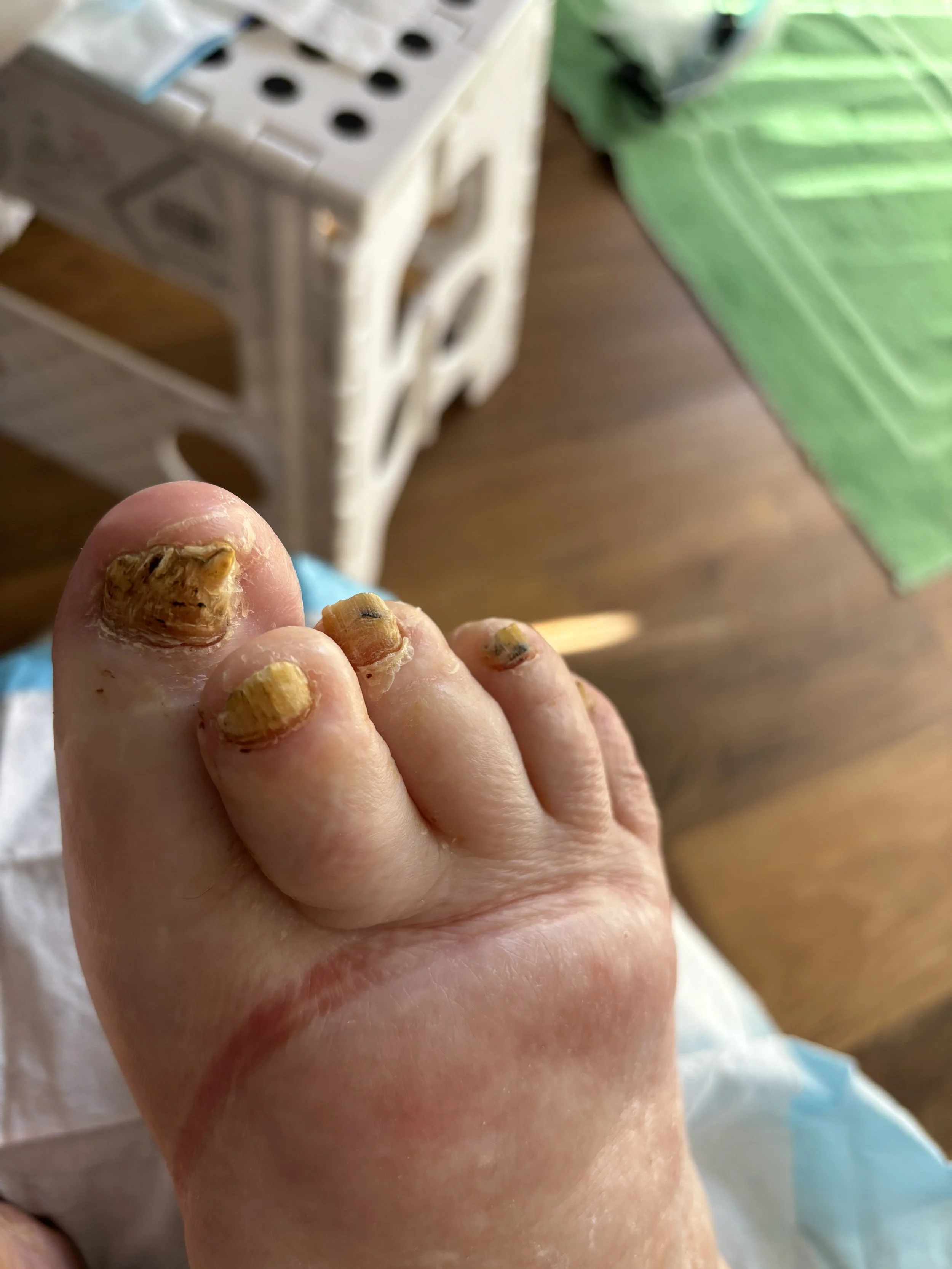 A person's foot with severely ingrown toenails, some of which are infected and appear discolored.