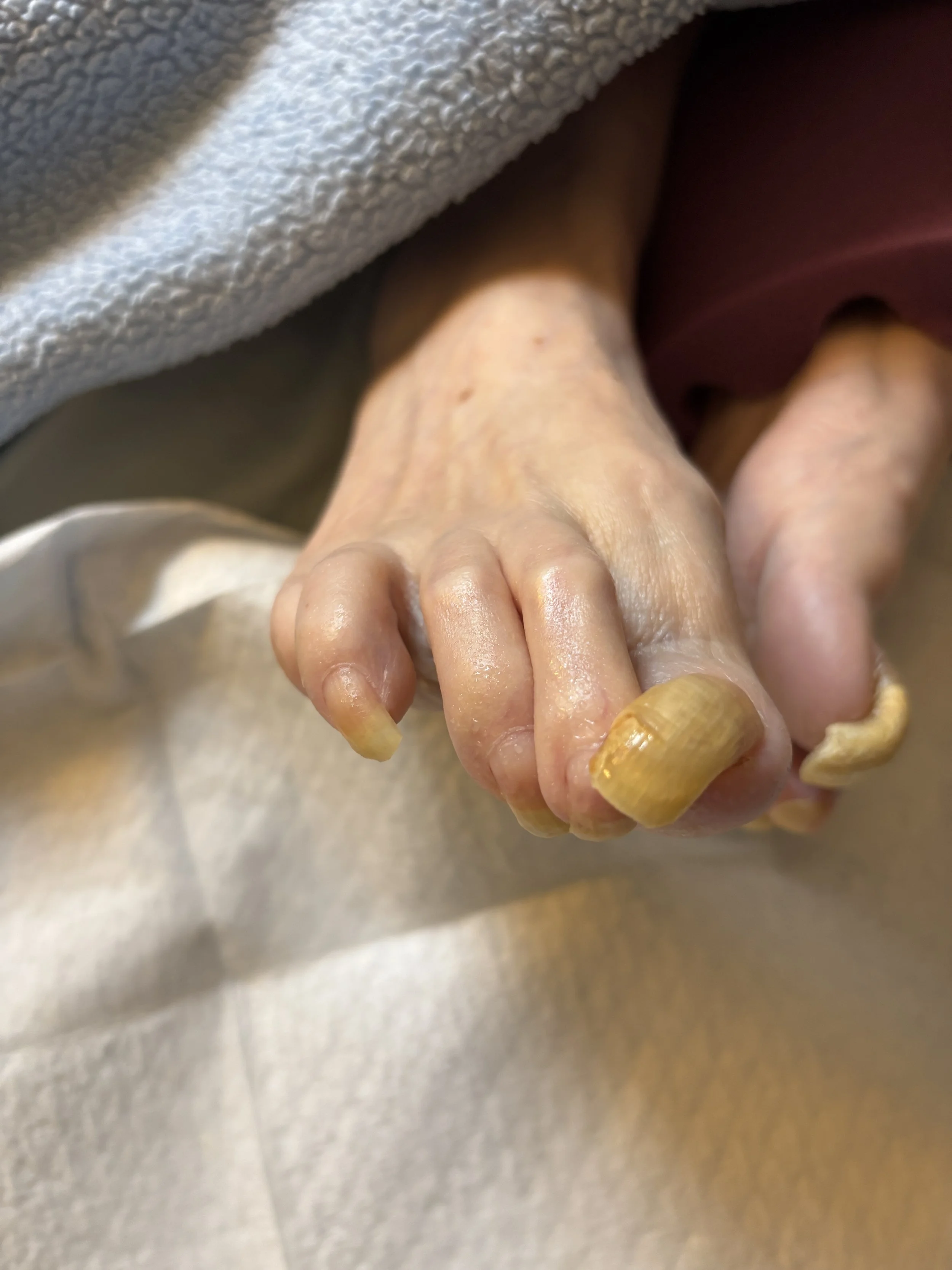 A close-up of an elderly person's toes with long, yellowed, damaged nails, resting on a surface.