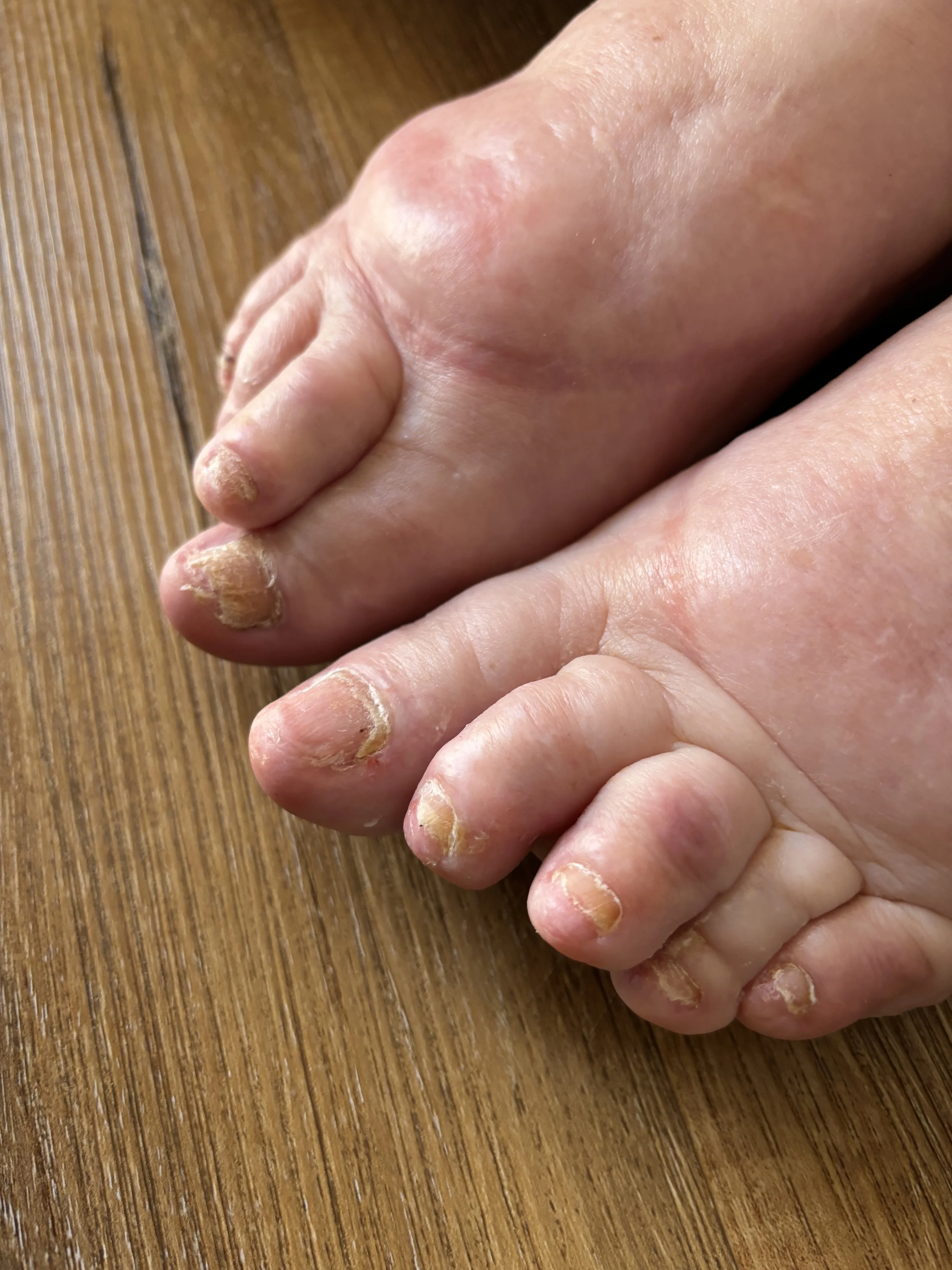 Close-up of a person's toes with thick, discolored, and peeling toenails on a wooden surface.