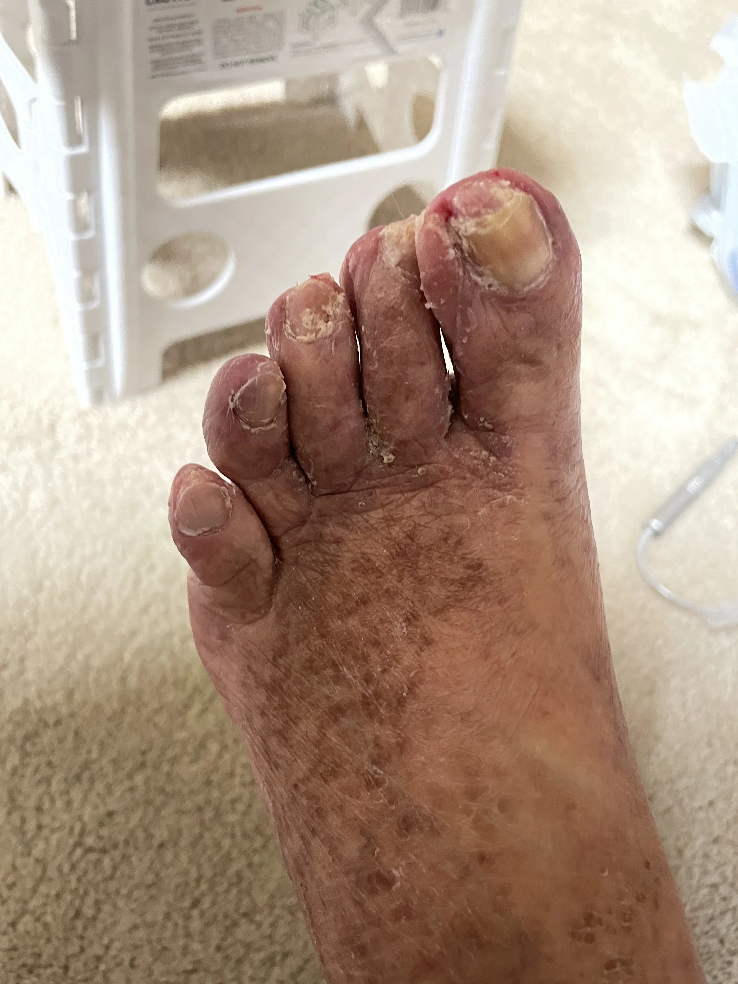 Close-up of a foot with multiple toes that are swollen, discolored, and have damaged, thickened nails, indicating possible infection or severe skin condition.