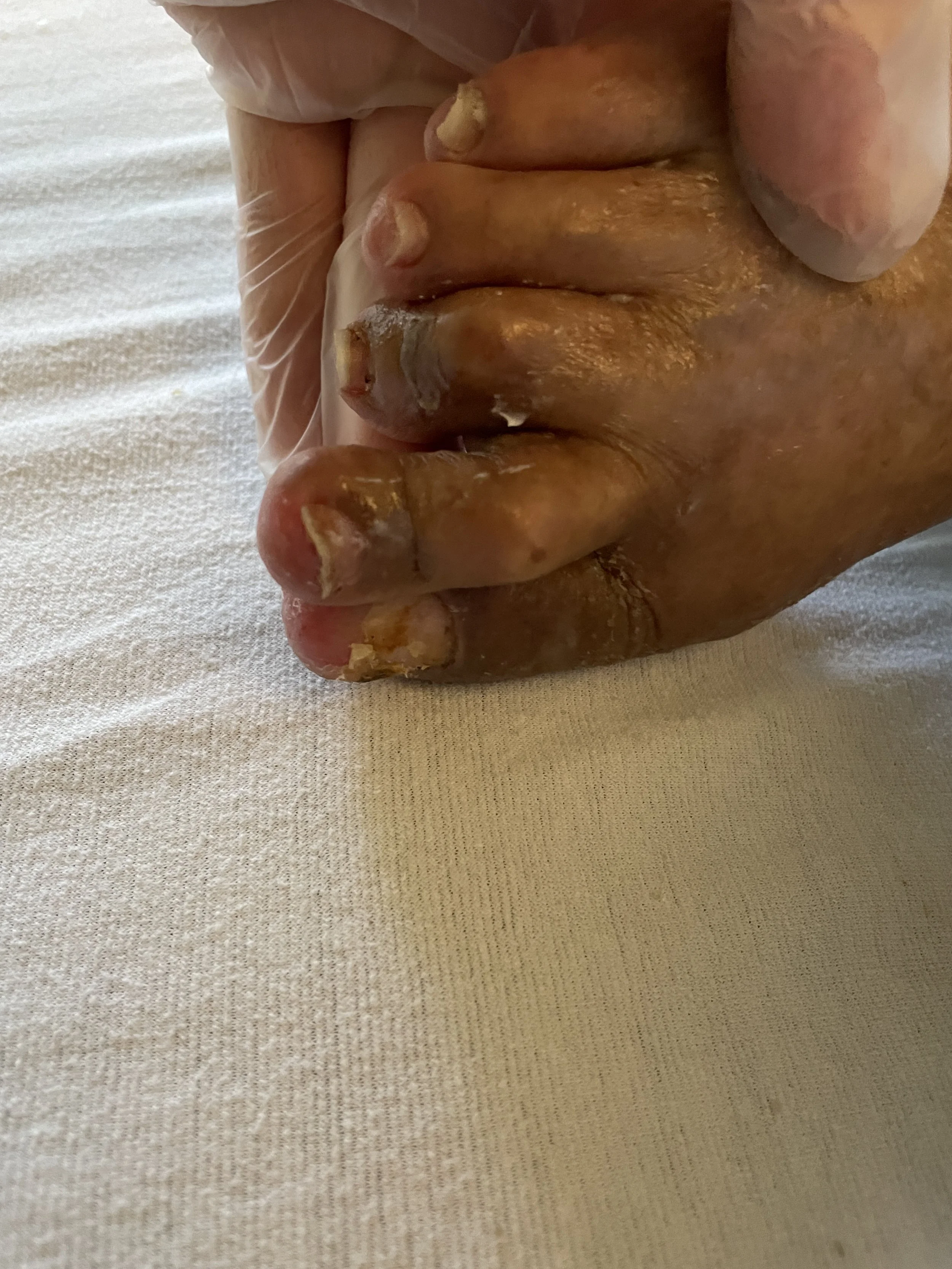 skilled nursing facility toenail trimming