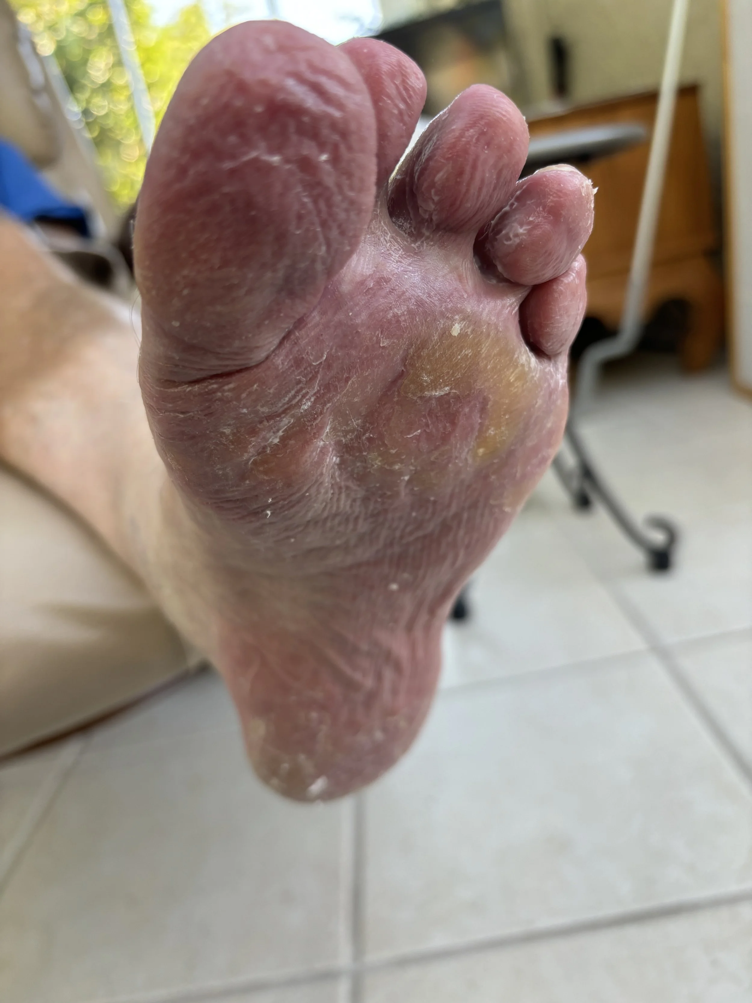 right foot after filing and lotion application