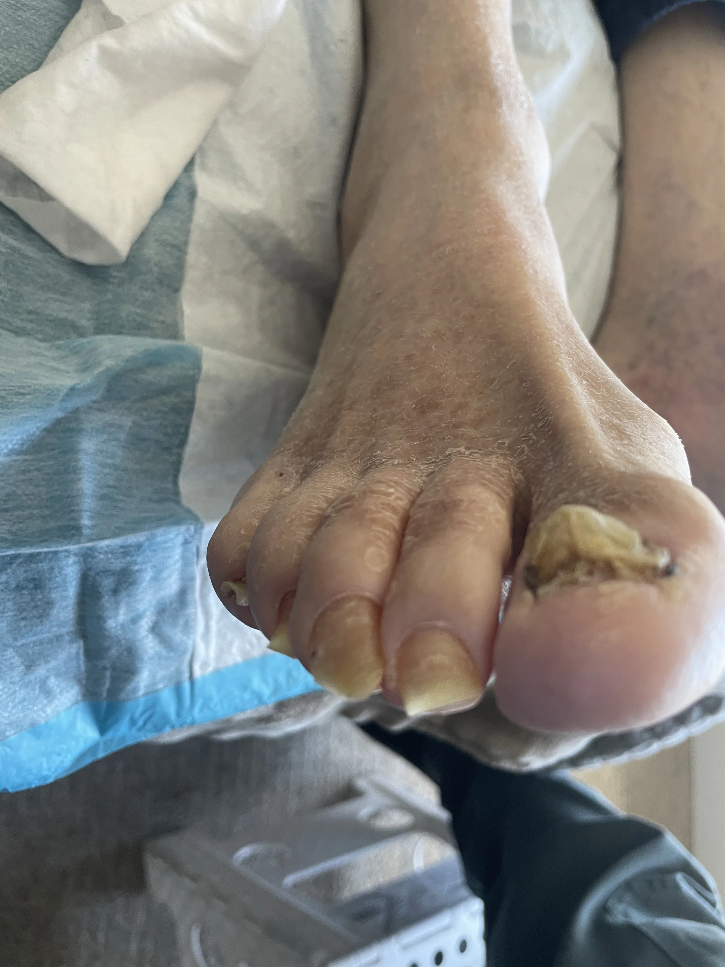Close-up of a person's foot with toenails, some of which are damaged or infected, on a medical examination table with paper cover.