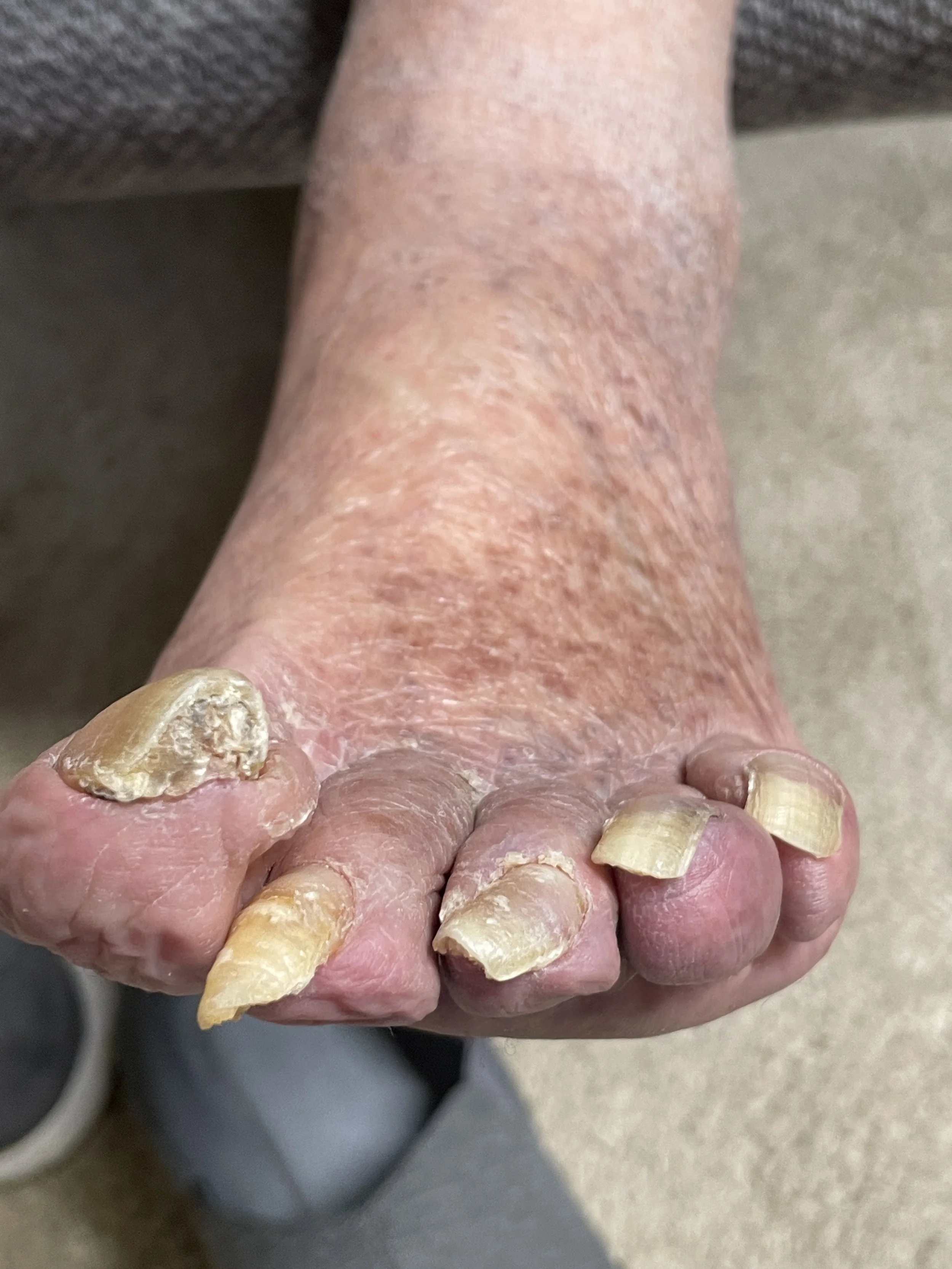Close-up of an elderly person's foot with thick, discolored, and damaged toenails, indicative of toenail fungal infection.