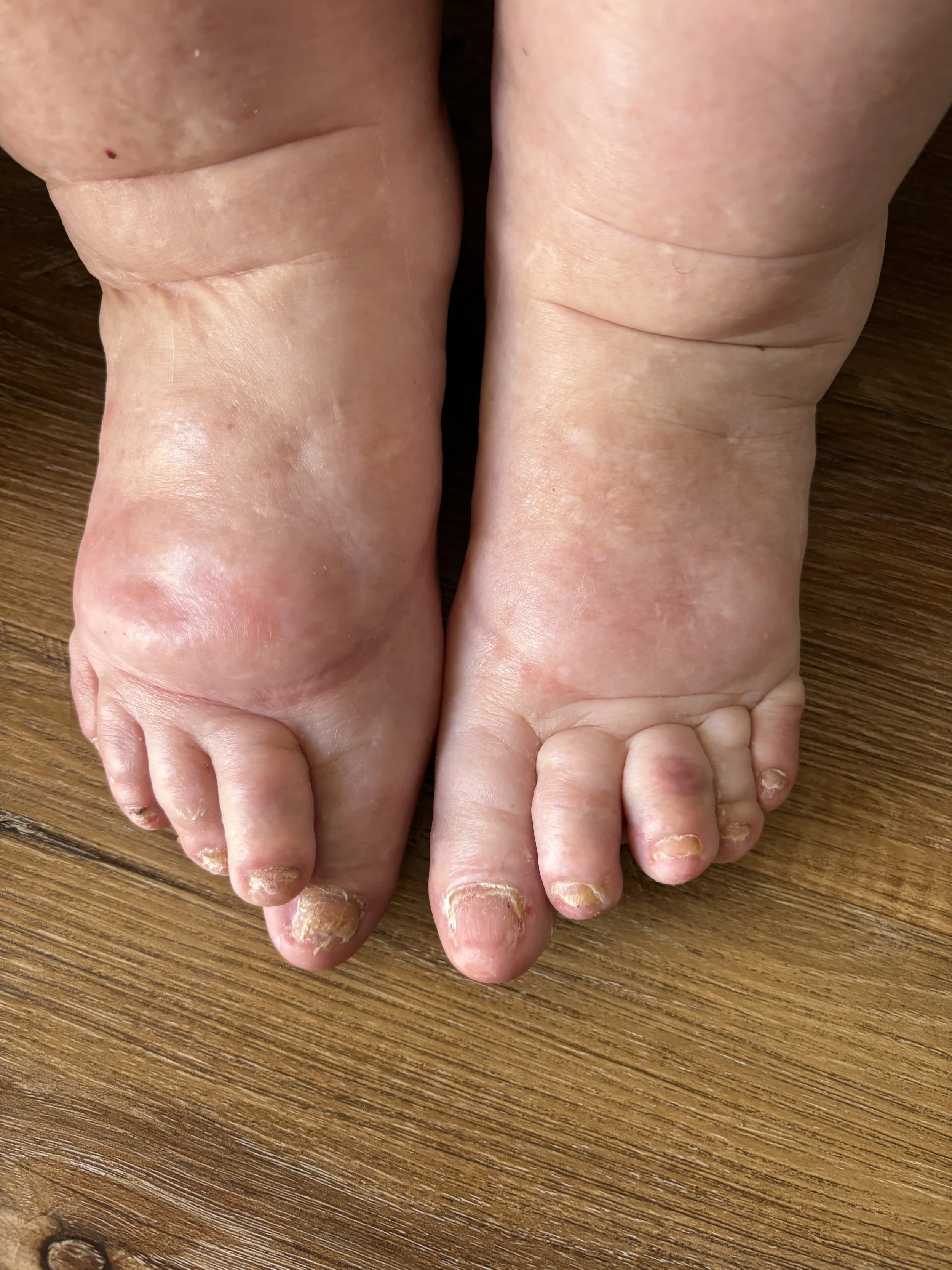 Close-up of worn, discolored toenails on both feet with dry and damaged skin, resting on a wooden surface.