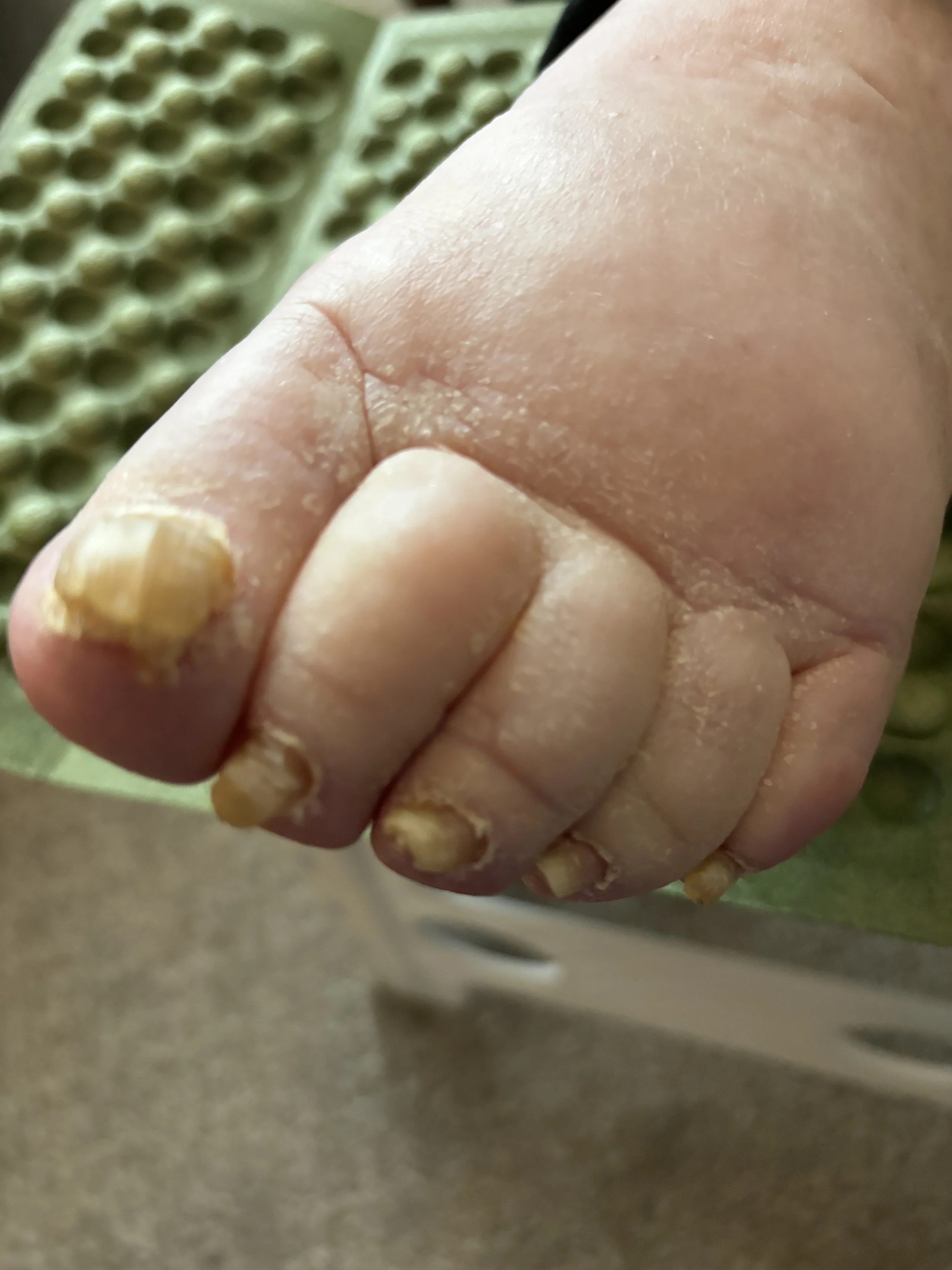 Close-up of a child's clenched fist with dirty, chewed fingernails.