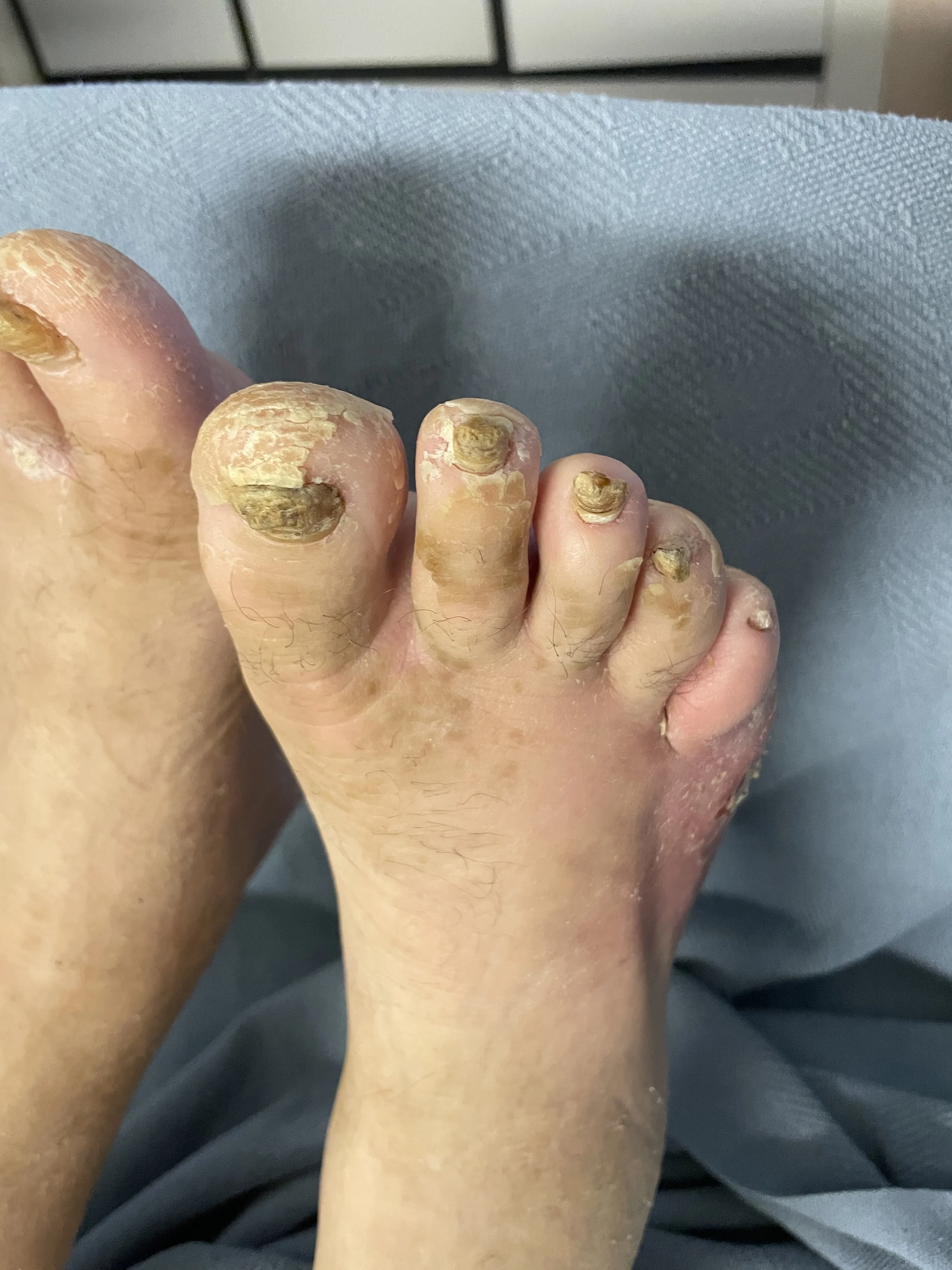 Foot with severely infected, thickened, and discolored toenails, indicating a fungal infection.