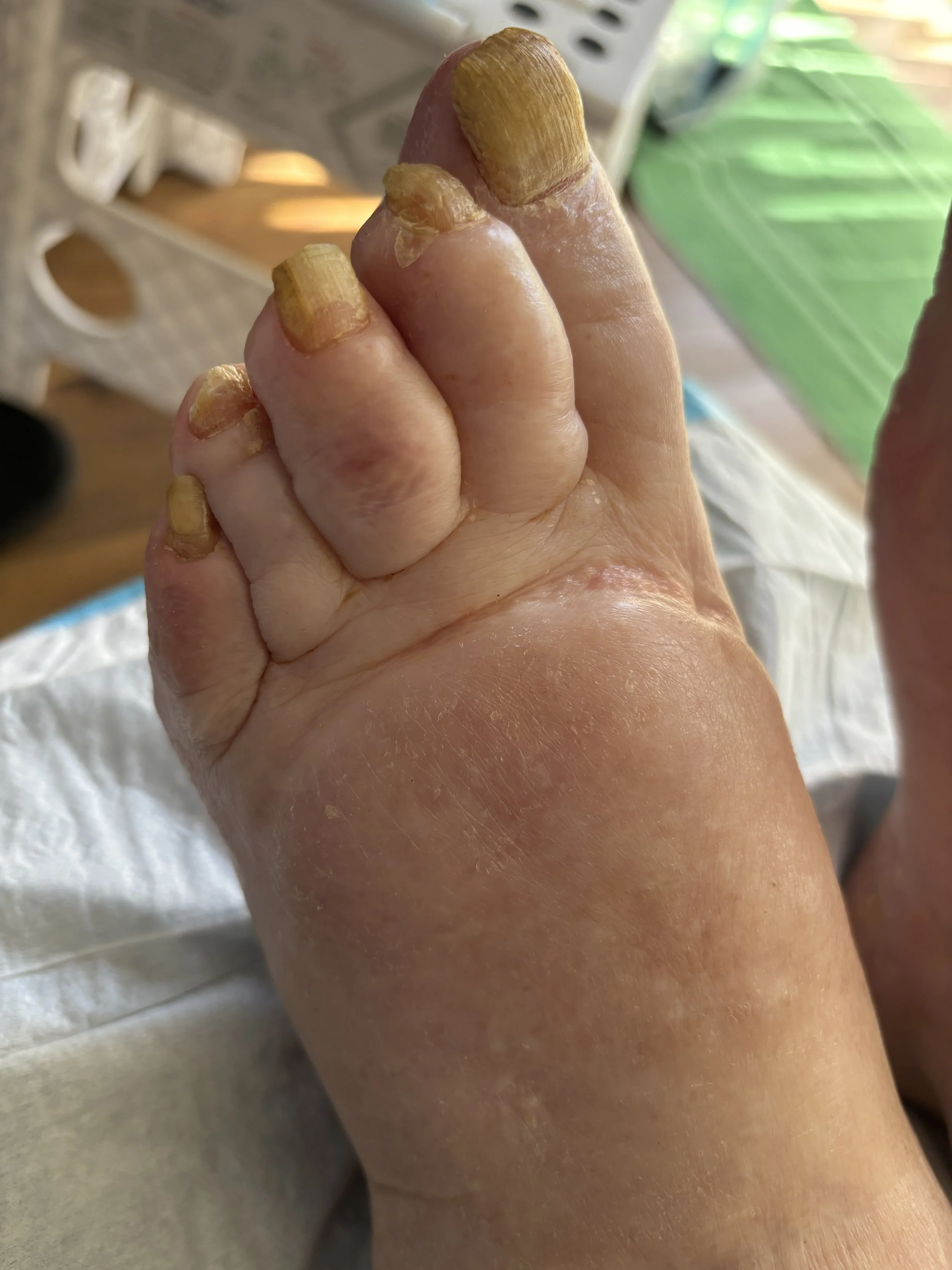 Close-up of a person's foot with thickened, discolored toenails and dry, peeling skin.