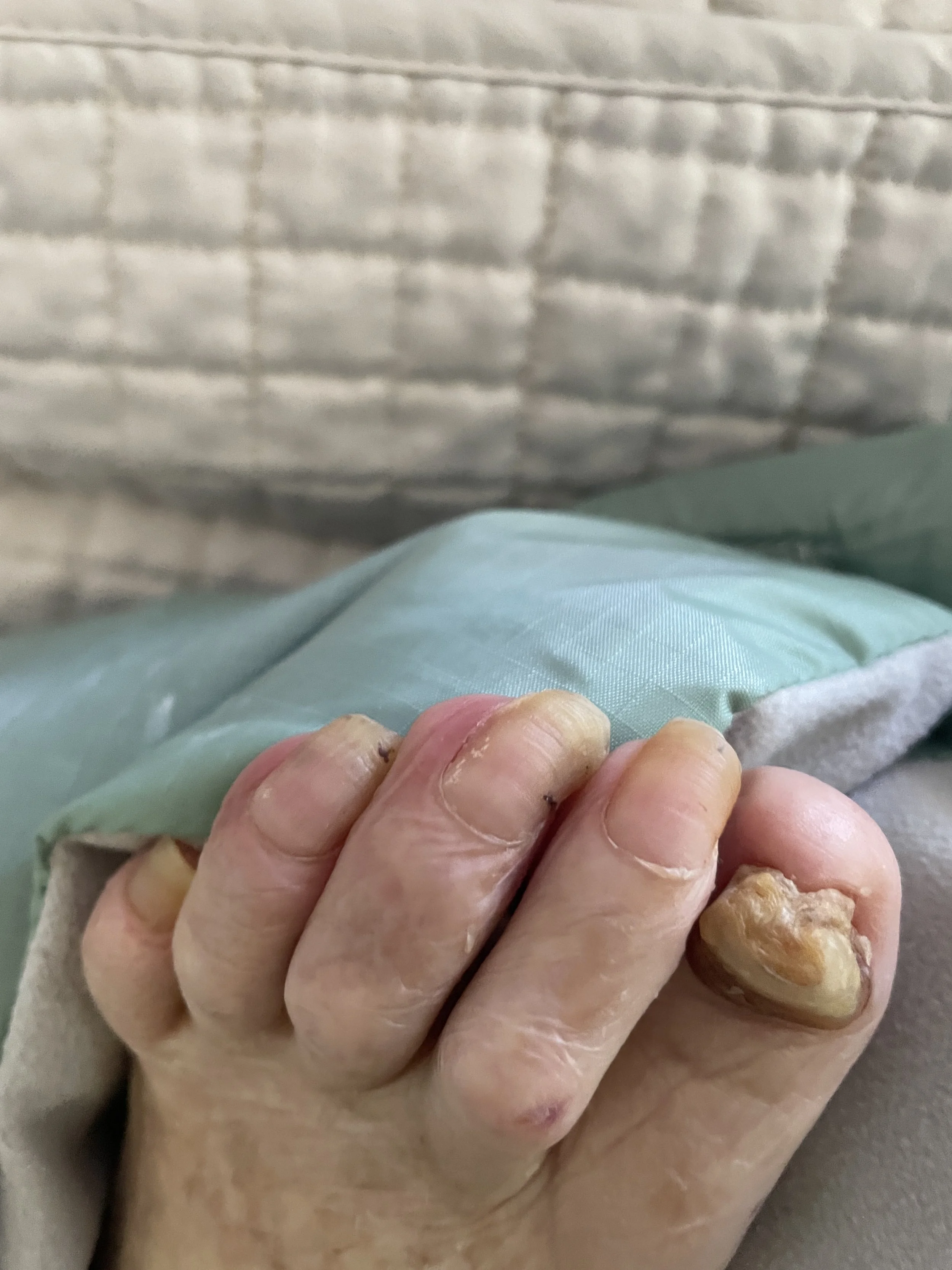 Close-up of an elderly person's hand with yellowish, thickened, and deformed fingernails resting on their lap with a textured fabric background.