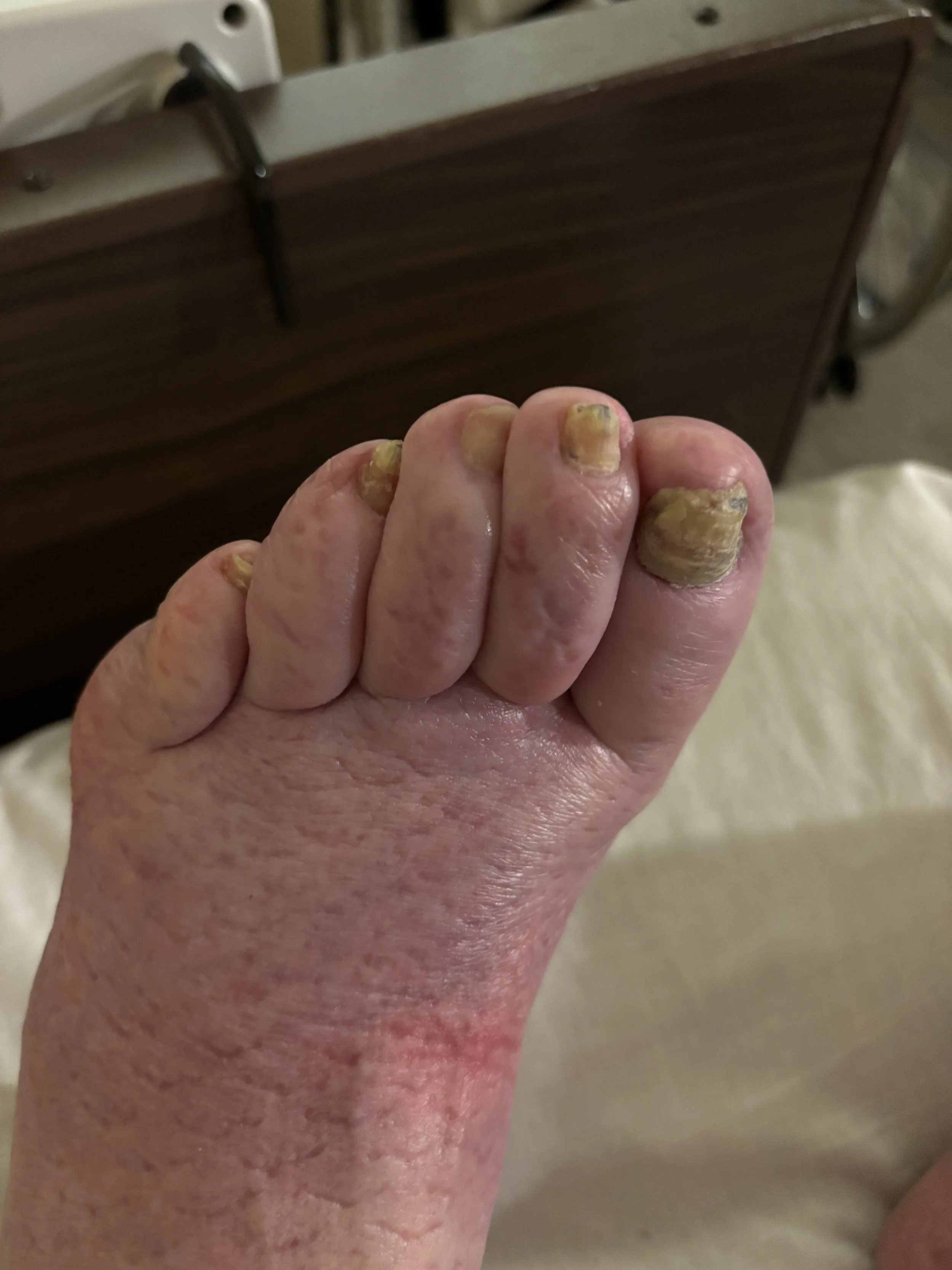 Close-up of a person's foot with thick, yellow, discolored toenails and dry skin.