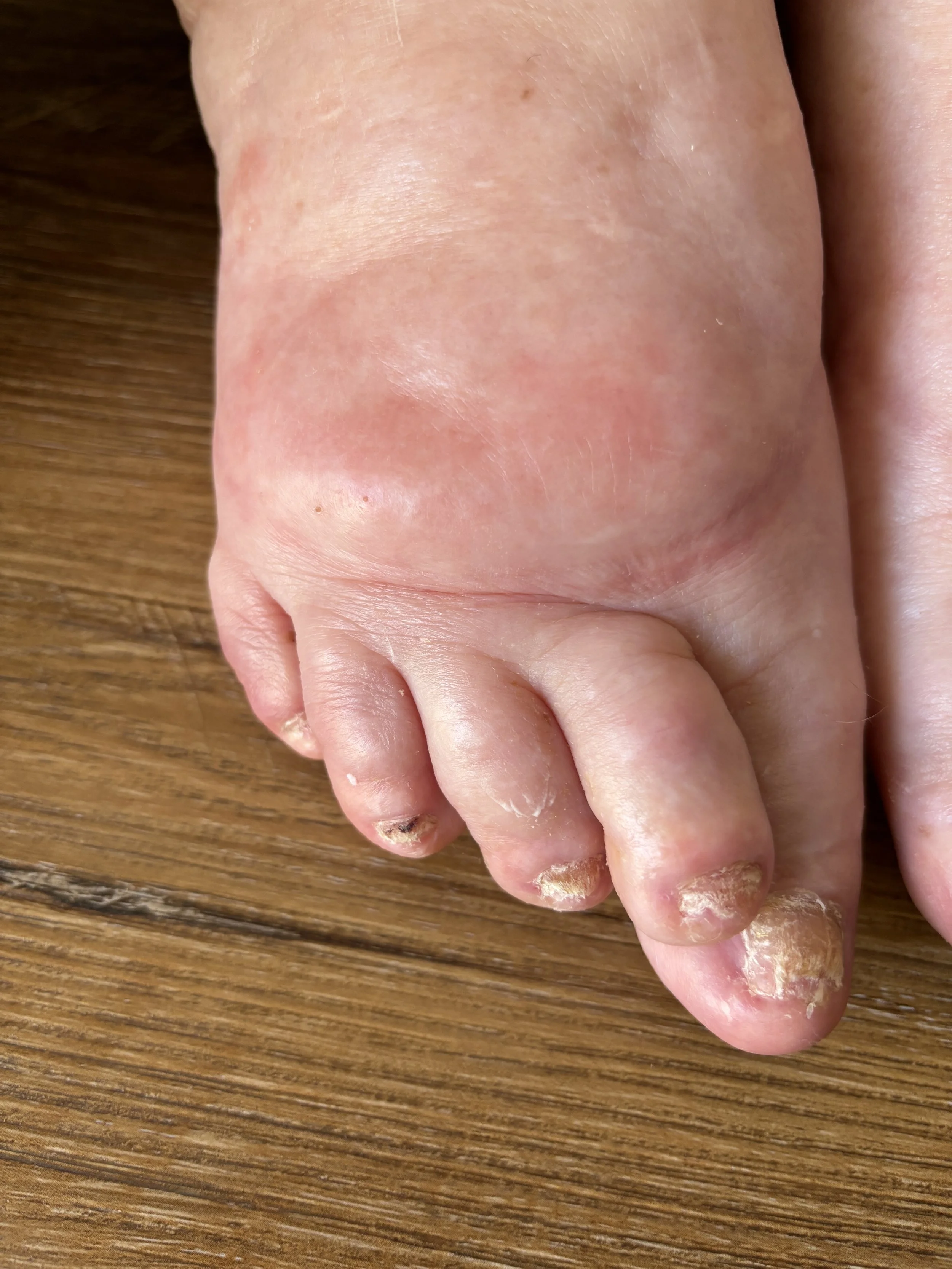 Close-up of a person's foot with fungal nail infections on the toenails, showing thickened, discolored, and peeling nails.