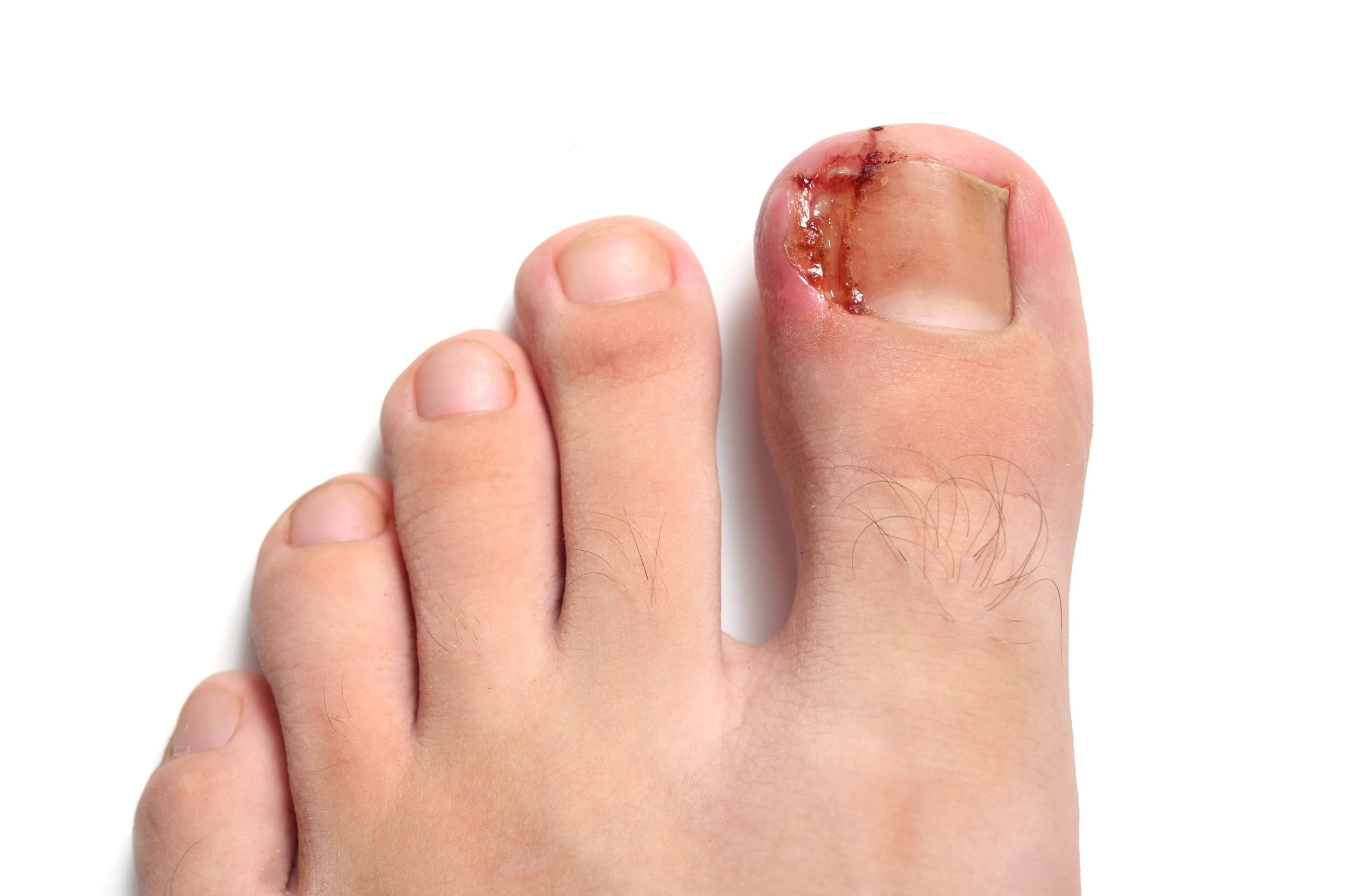 Close-up of a human foot with an injured big toe showing a damaged toenail and surrounding skin.
