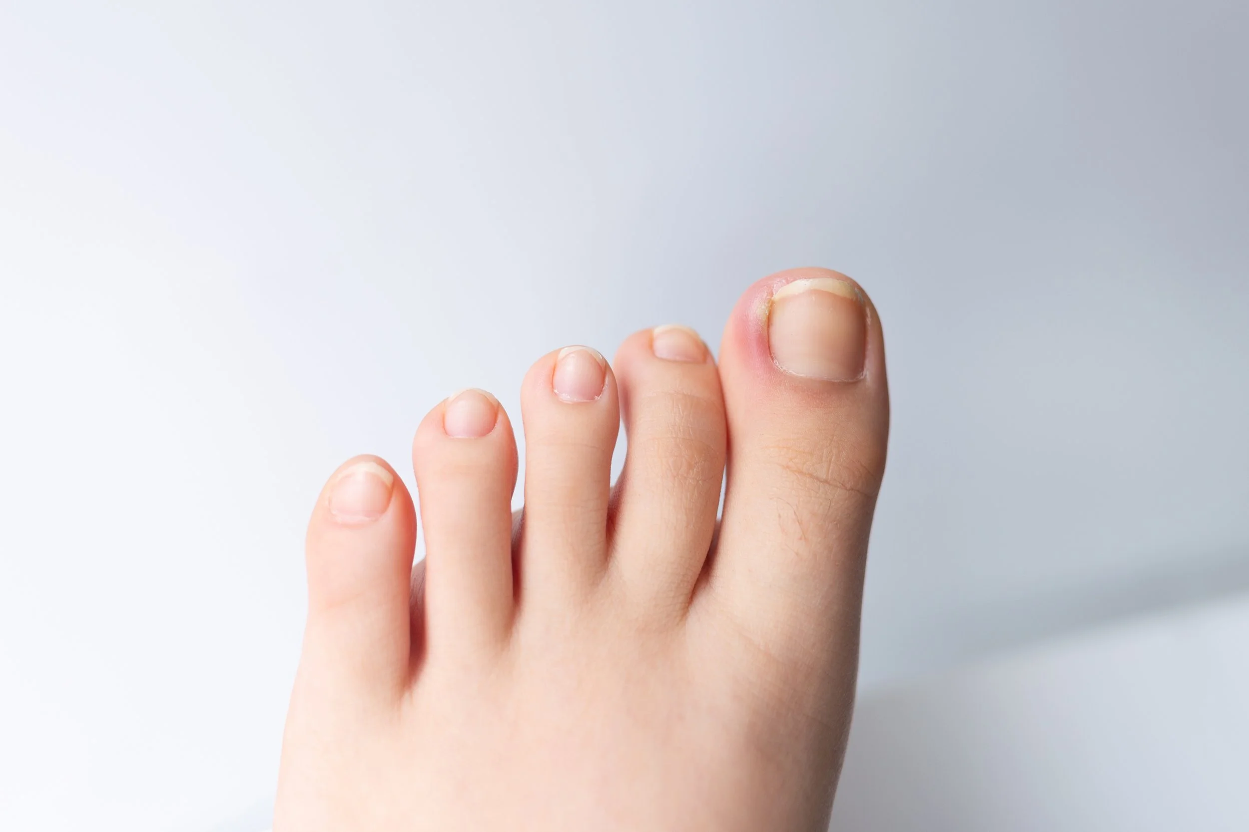 Understanding Ingrown Toenails: Causes, Treatment & Prevention