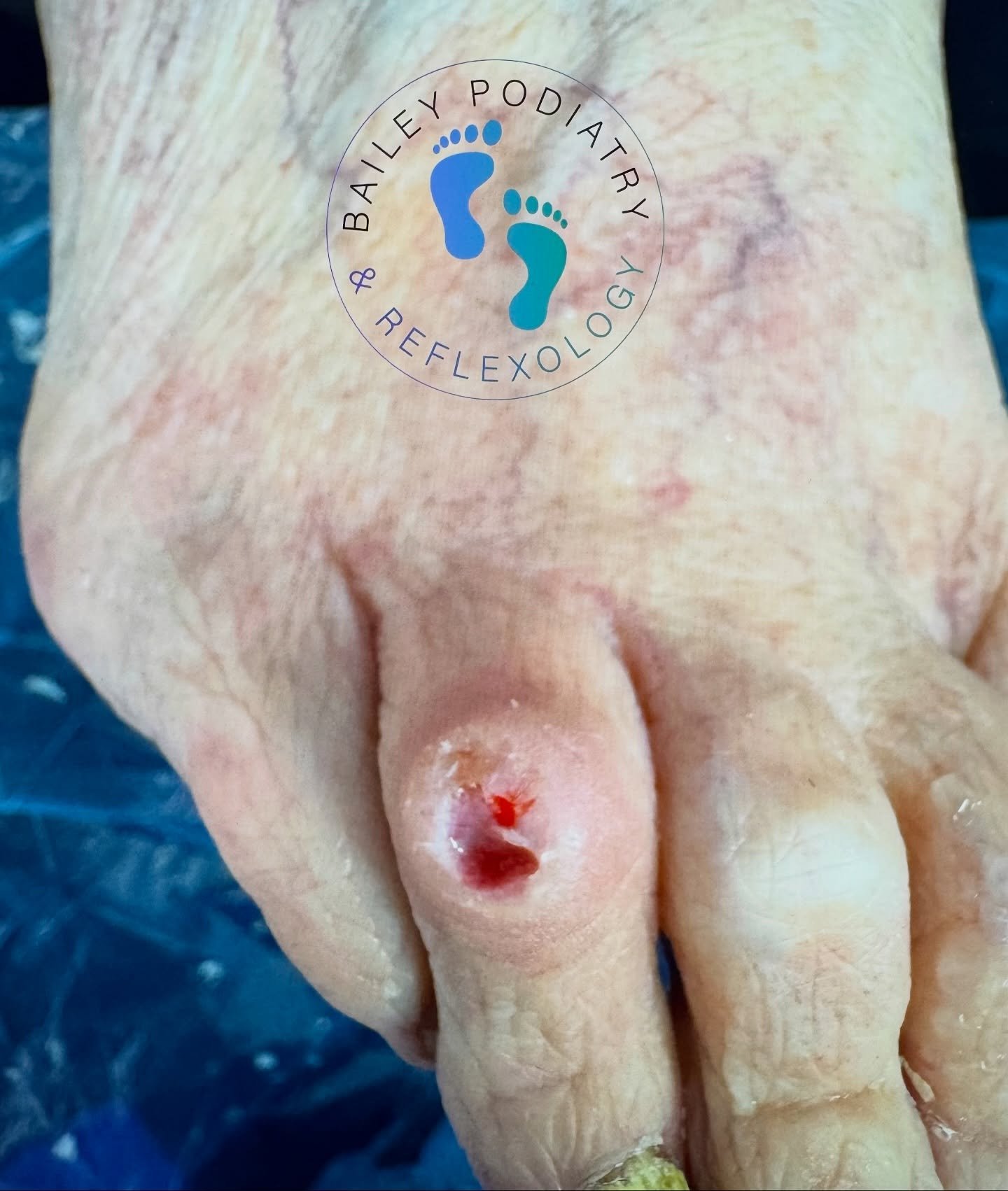 ✨ Feet First Friday: Wound Care in Clinic ✨ 
This patient lives with Rheumatoid Arthritis, which can make skin more fragile and slower to heal &mdash; especially over bony areas like the dorsal aspect of the 4th toe joint.

A difference a week can ma