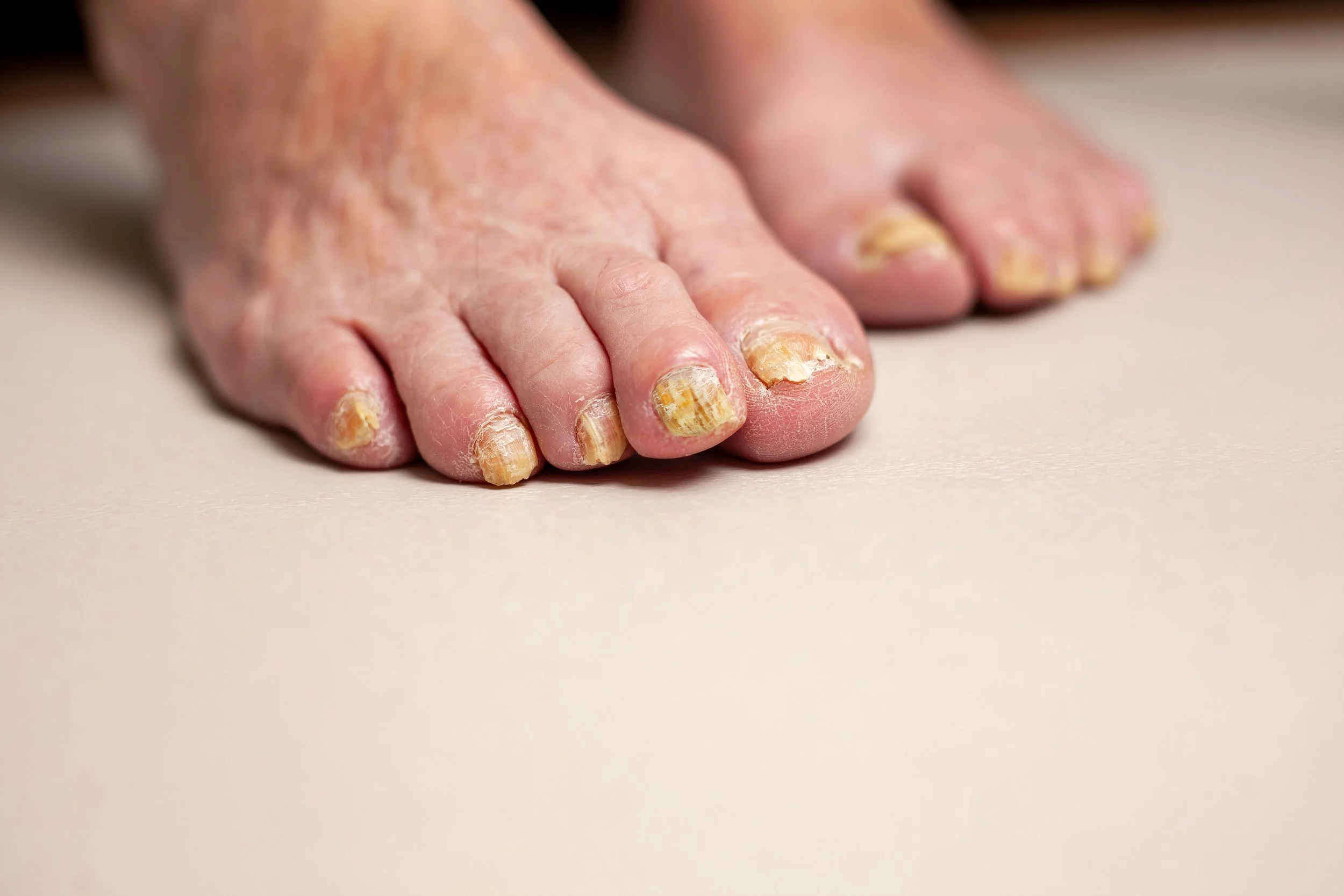 Fungal Nail Infection: What You Need to Know