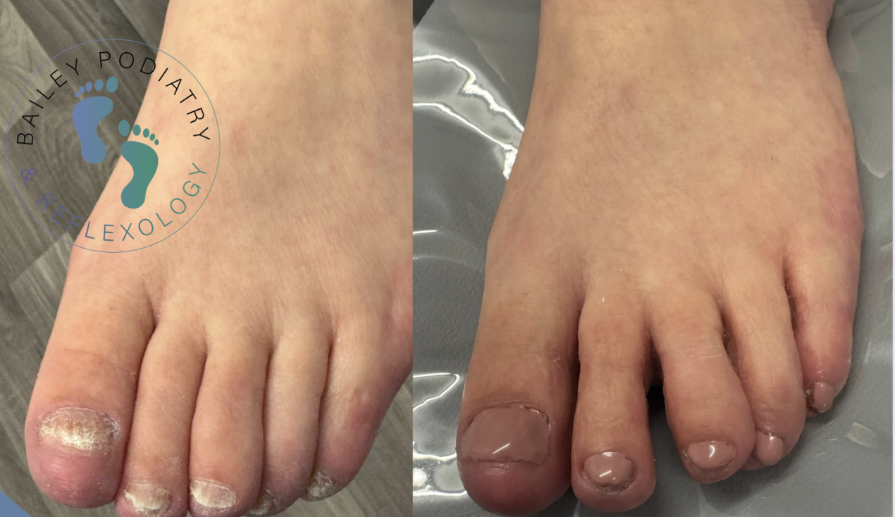 Toenail Reconstruction for Damaged or Fungal Nails