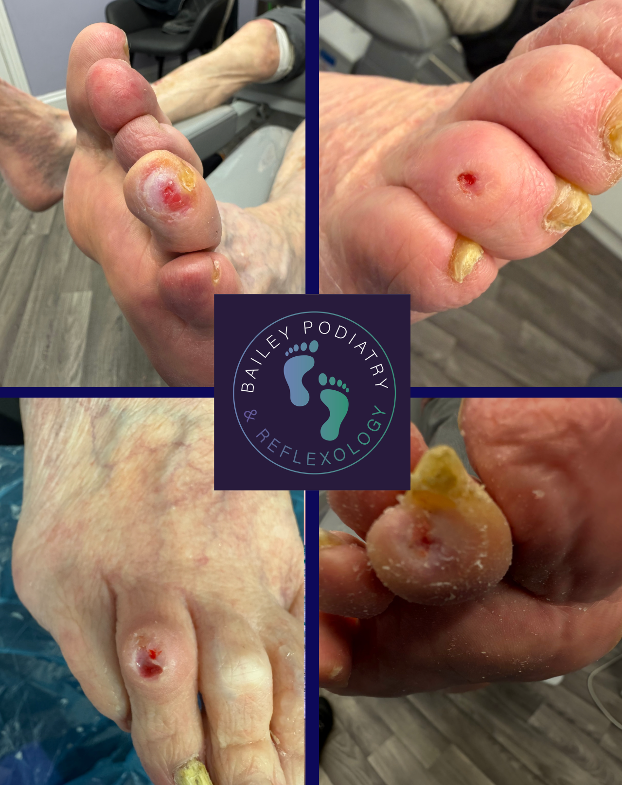 Why Small Foot Lesions Should Never Be Ignored in High-Risk Patients