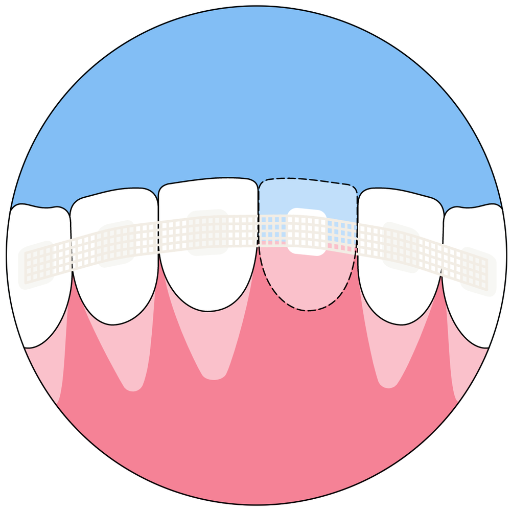 Splinting — BOST CLINIC