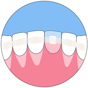 Splinitng Incision Splinting — BOST CLINIC