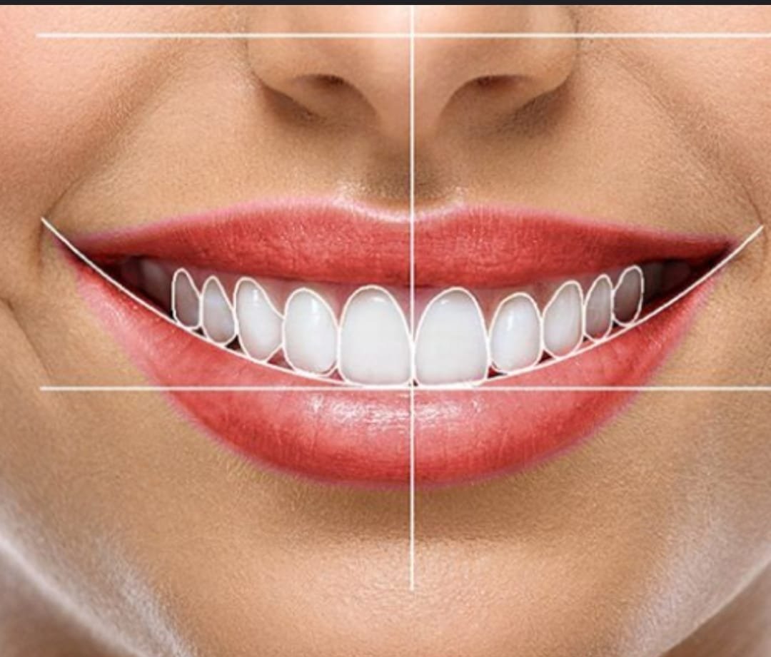 Diseño de Sonrisa 