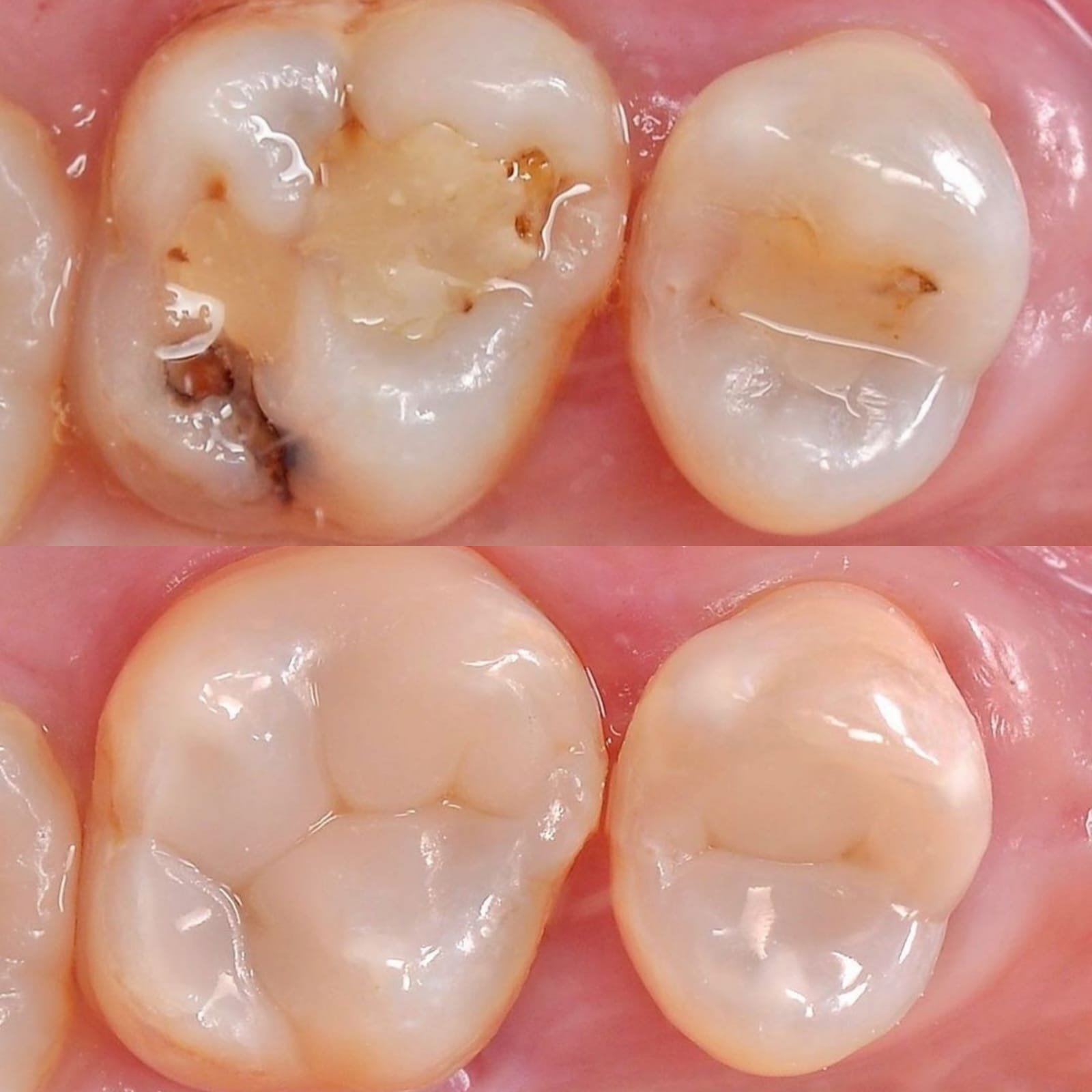 Resinas Dentales Estéticas 