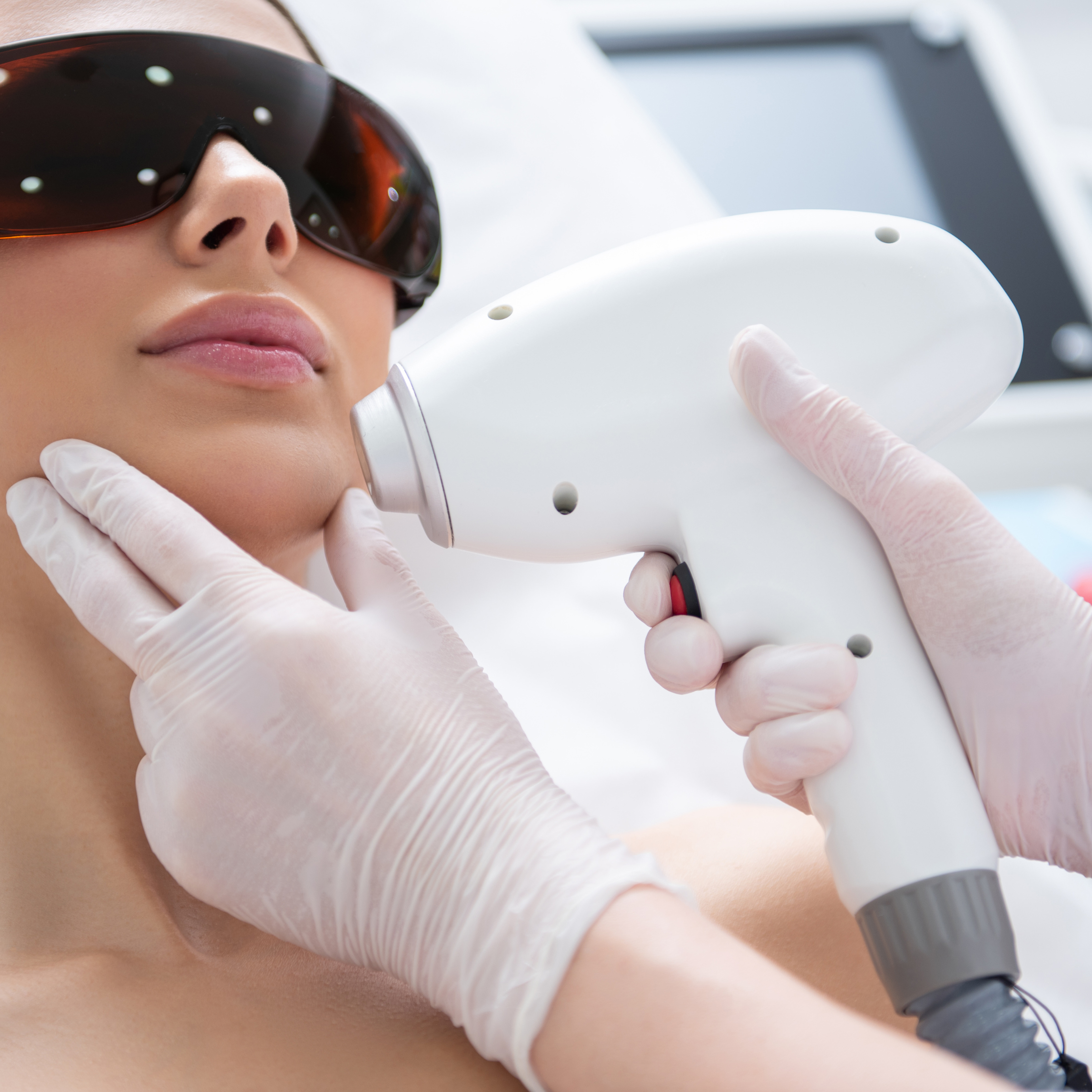 IPL rosacea laser treatment acne treatment Ashburn Virginia