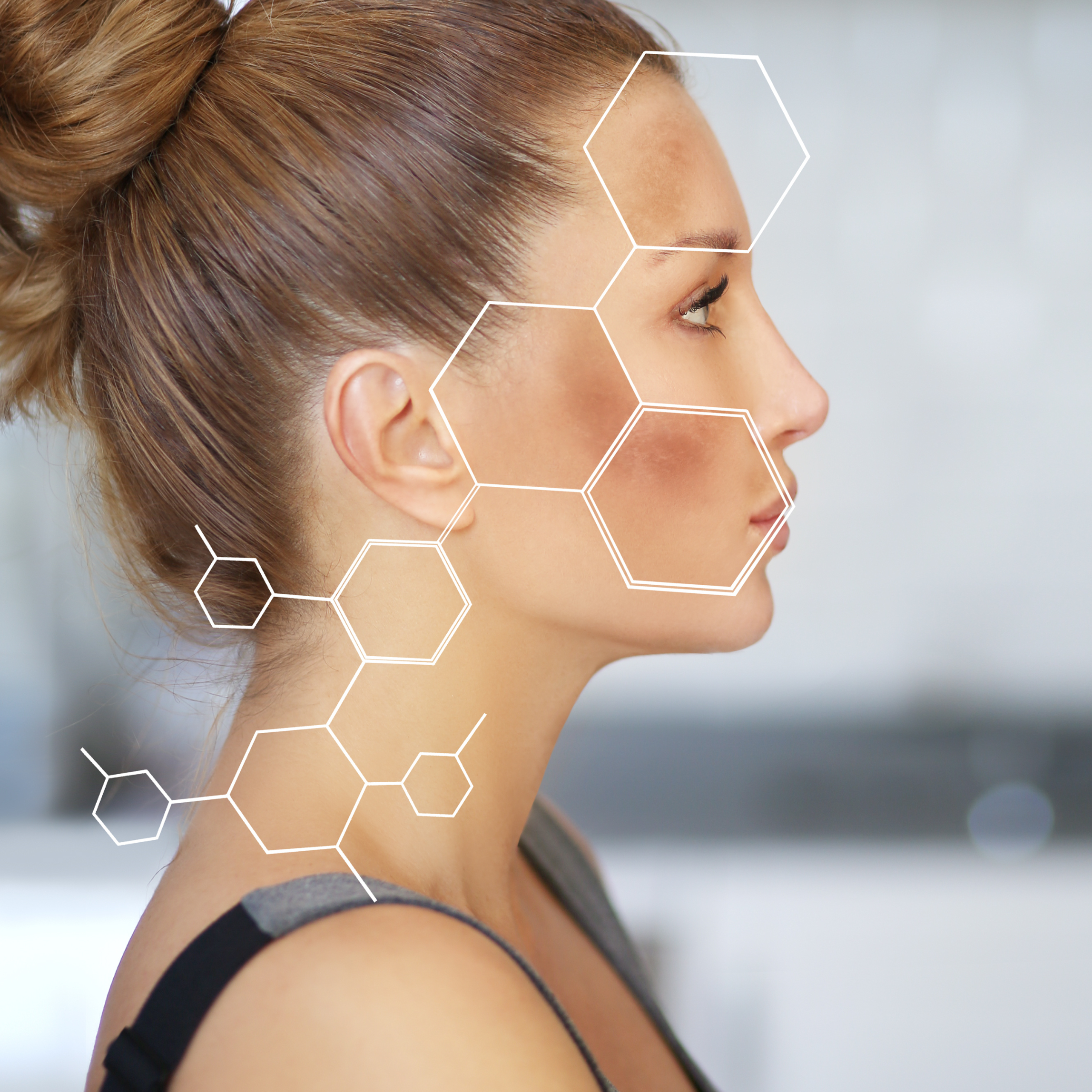 IPL hyperpigmentation rosacea Ashburn VA Loudoun County