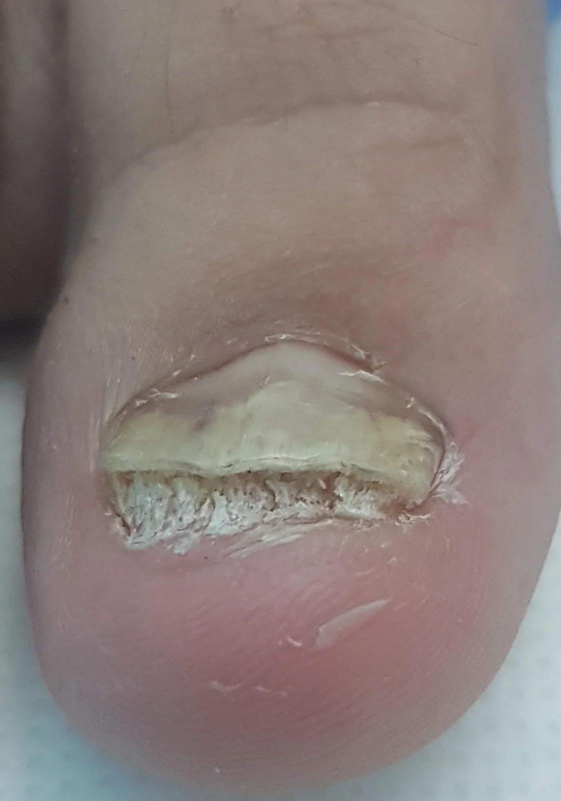 Micología en San Luis Potosí: ¿Cómo saber si tienes hongos en uñas o piel y qué estudio necesitas?