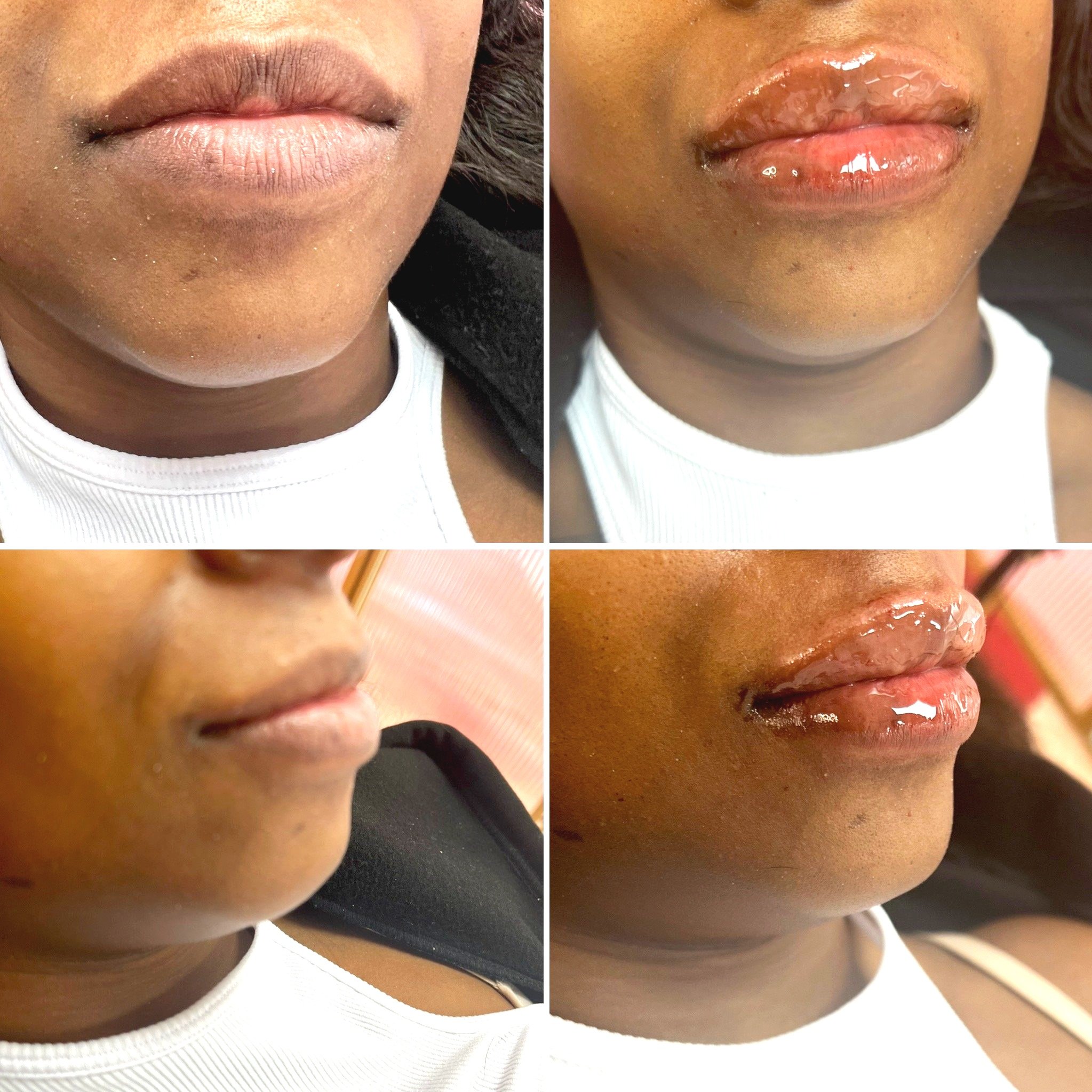Hyaluronic acid lip filler