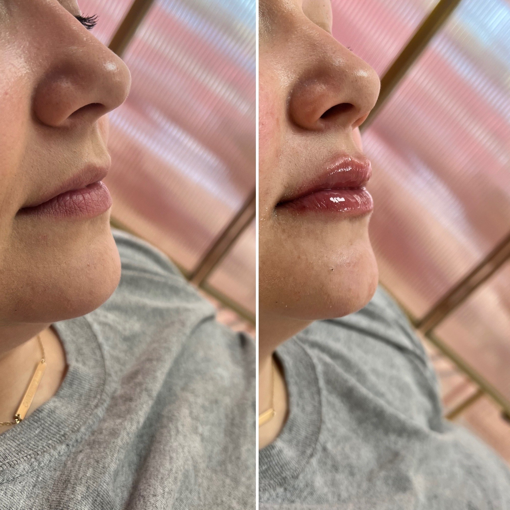 Hyaluronic acid lip filler