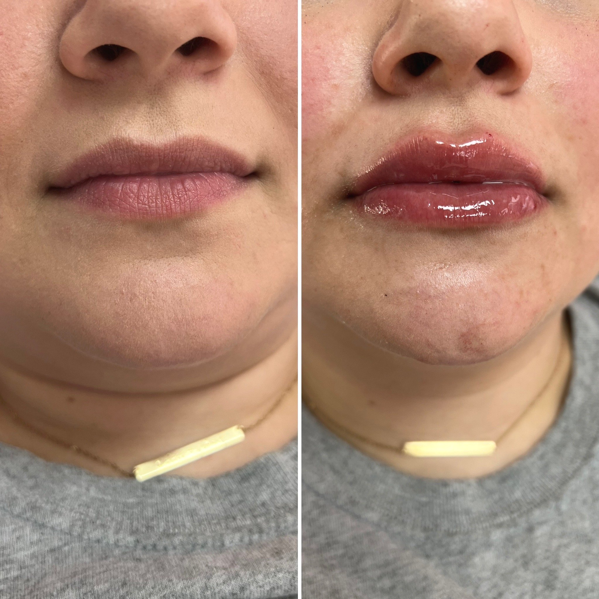 Hyaluronic acid lip filler