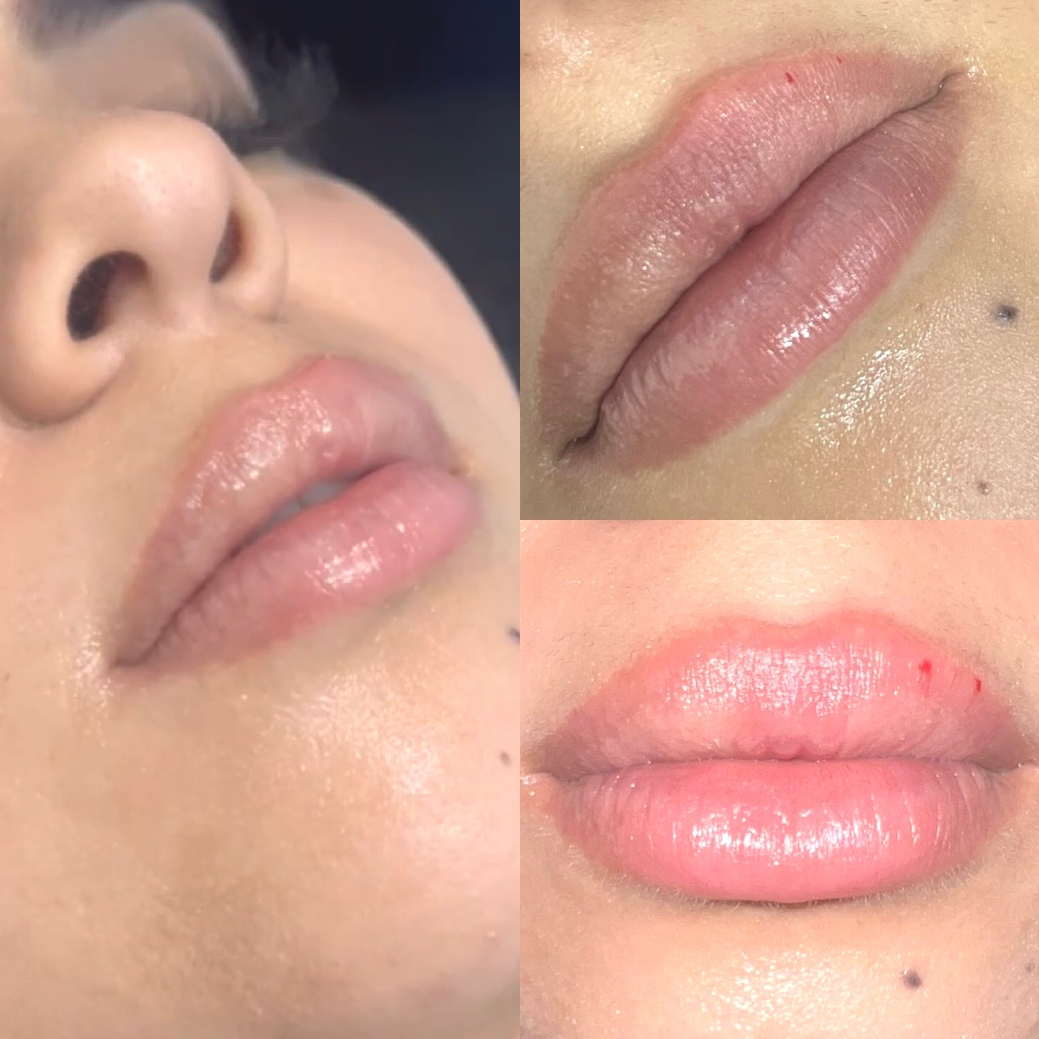 Hyaluronic acid lip filler