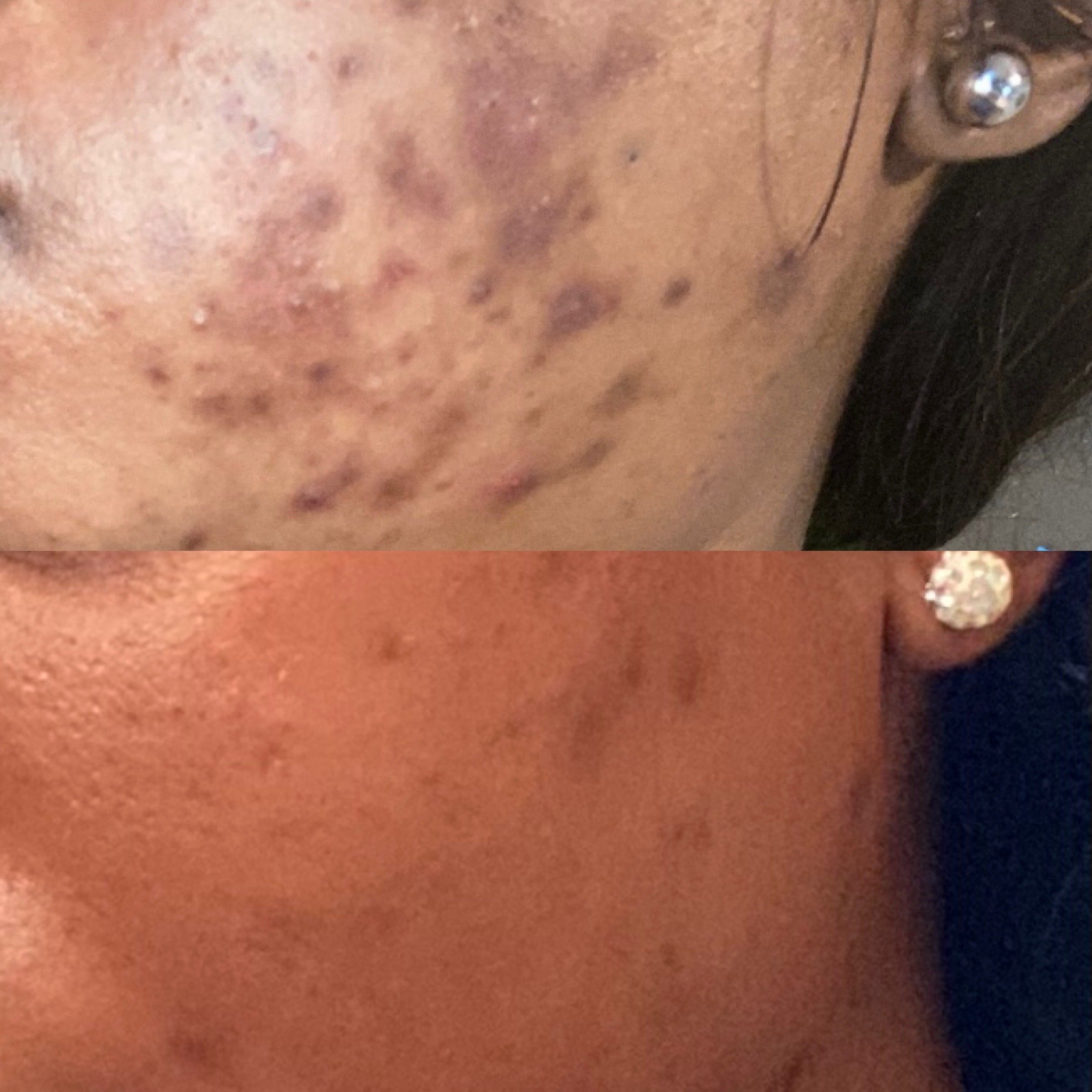 Microneedling for acne scars