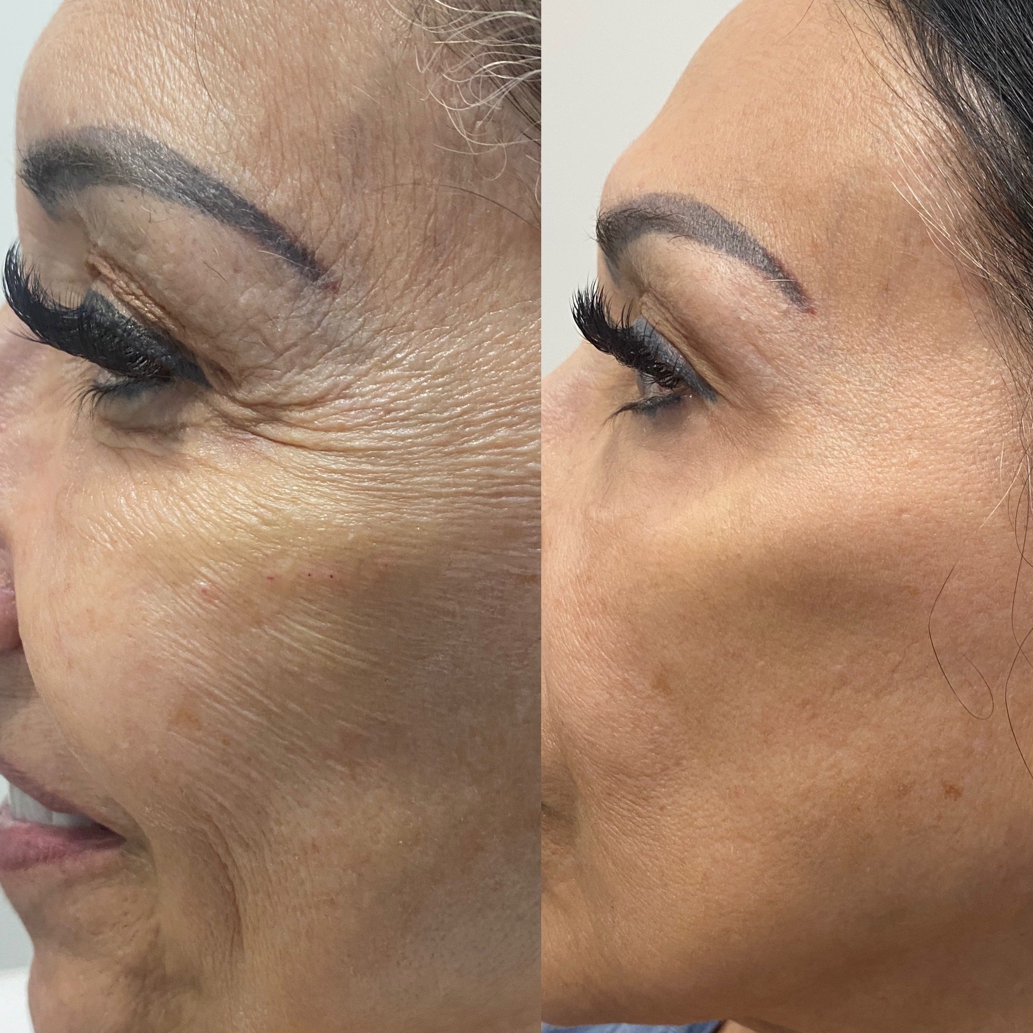 Hyaluronic acid dermal filler and Botox