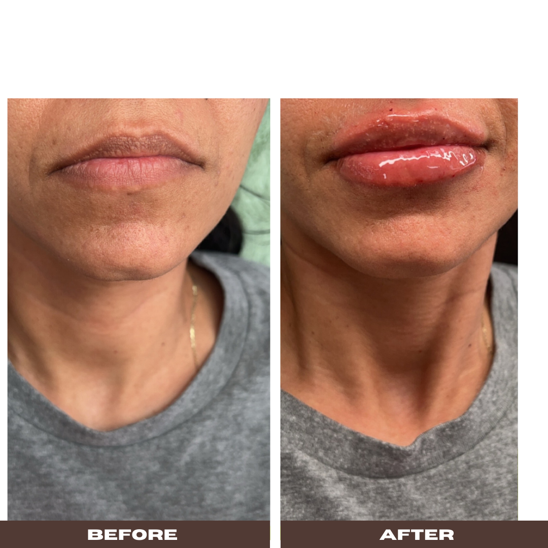 Half syringe of lip filler