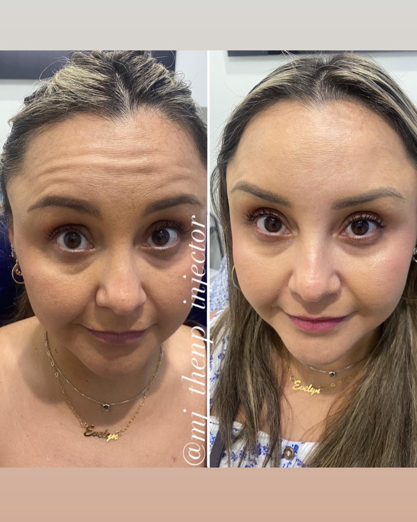 Botox