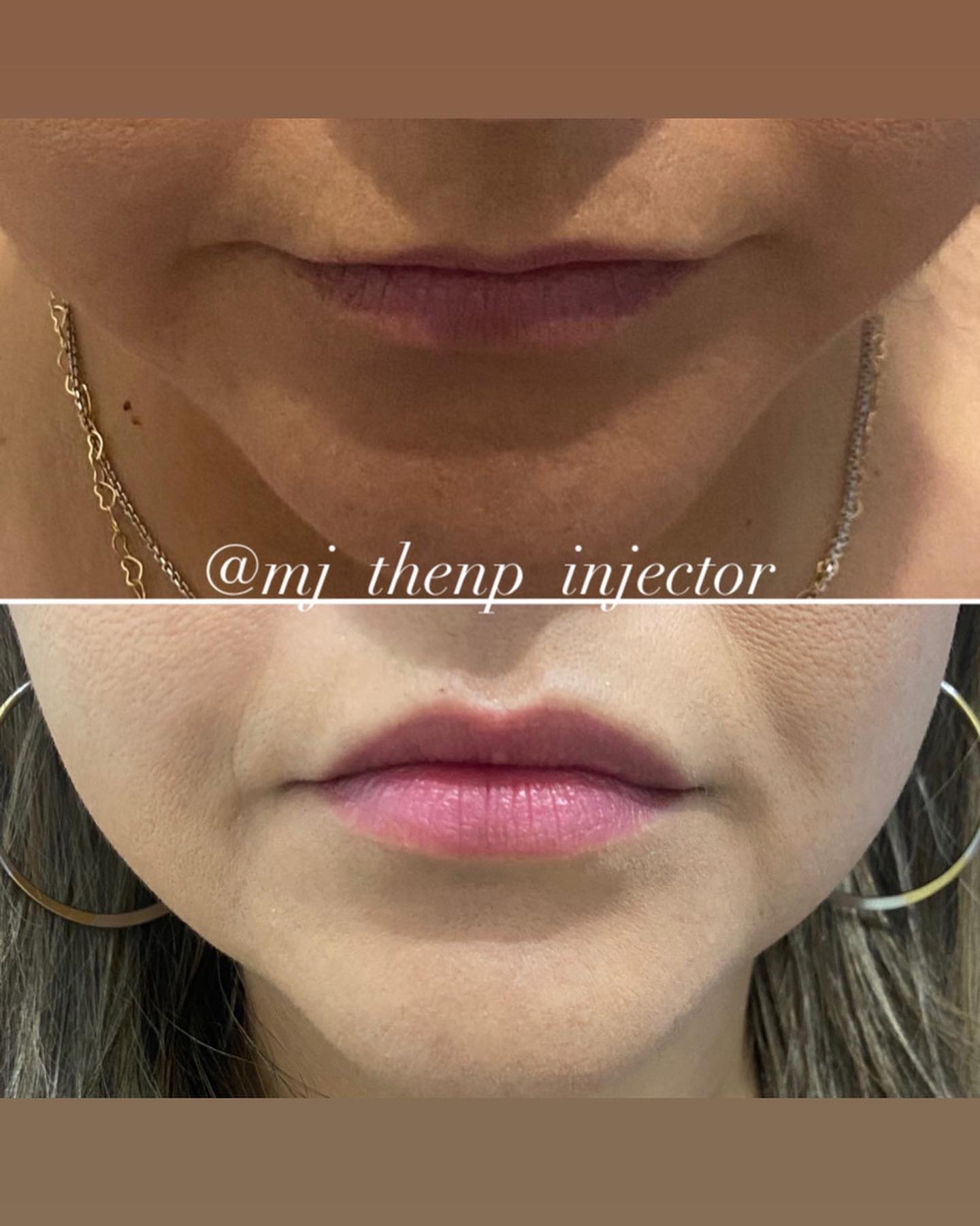 Lip flip with Botox