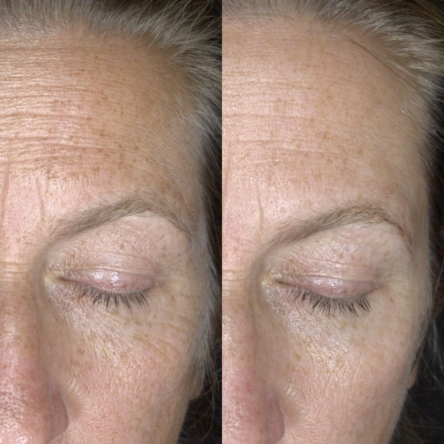 Did you know there is an alternative to anti-wrinkle injections that can still give you incredible results?

&ndash; Venus Viva &ndash;

This client has had 3 x Venus Viva resurfacing treatments to target texture, fine lines and pigmentation. Over th