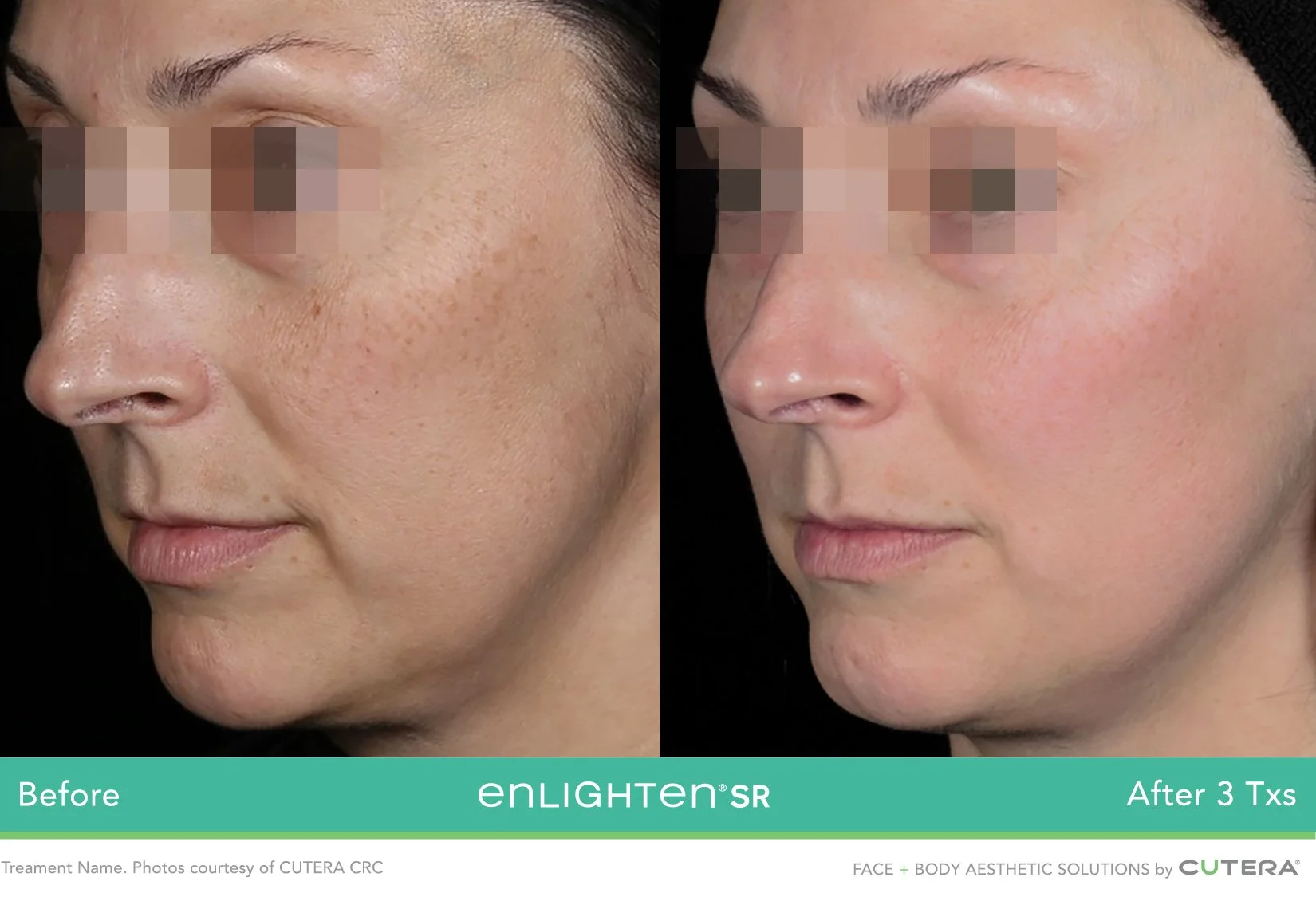 Enlighten SR pico genesis before and after