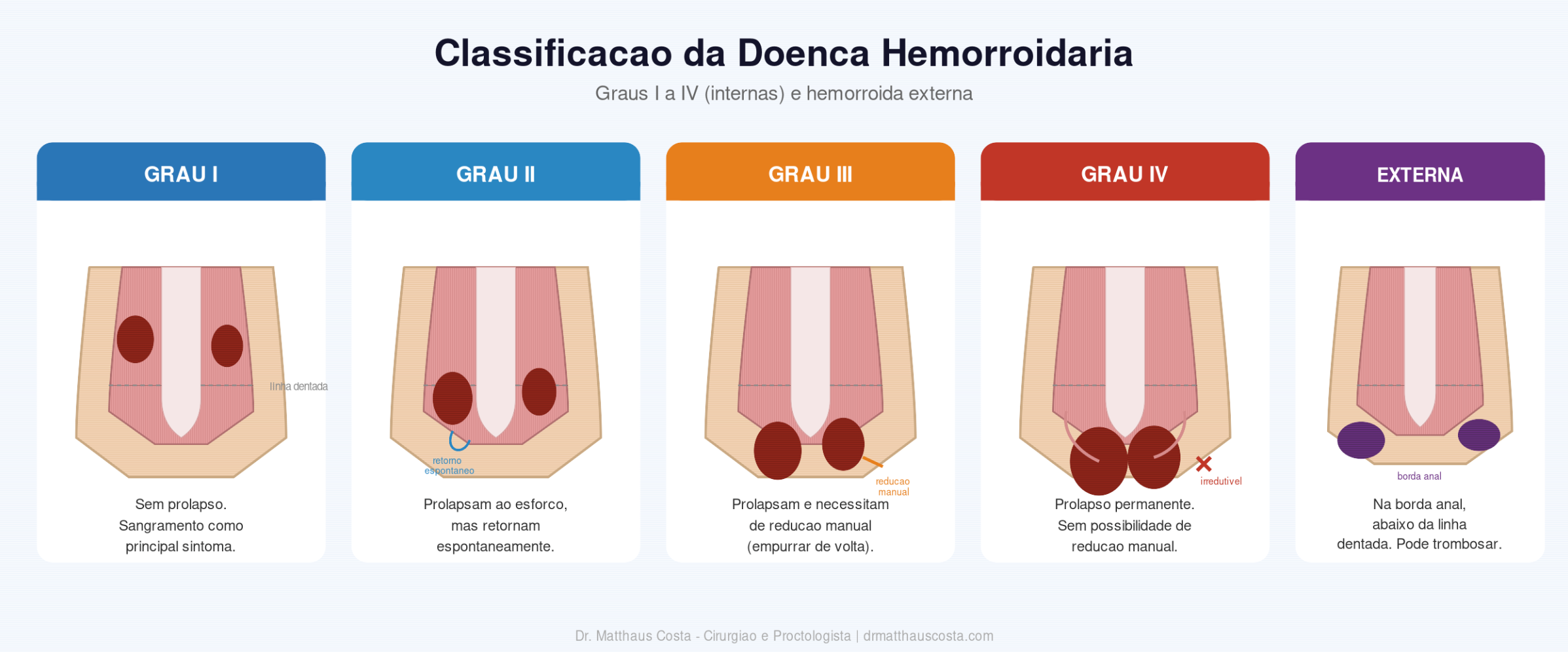 Infográfico sobre classificação da doença hemorrroidária, com cinco categorias de grau, de I a IV, e externa. Cada categoria apresenta uma ilustração do ânus com manchas roxas indicando as hemorroidas, acompanhada de descrição do estágio e características específicas.