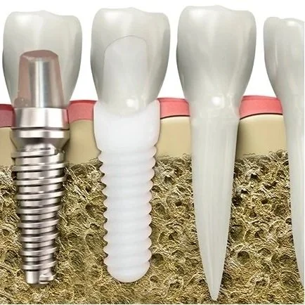 Close-up illustration of four different types of dental implants and natural teeth, including a metal implant, a ceramic implant, a natural tooth, and another type of artificial tooth, with surrounding gums and jawbone.