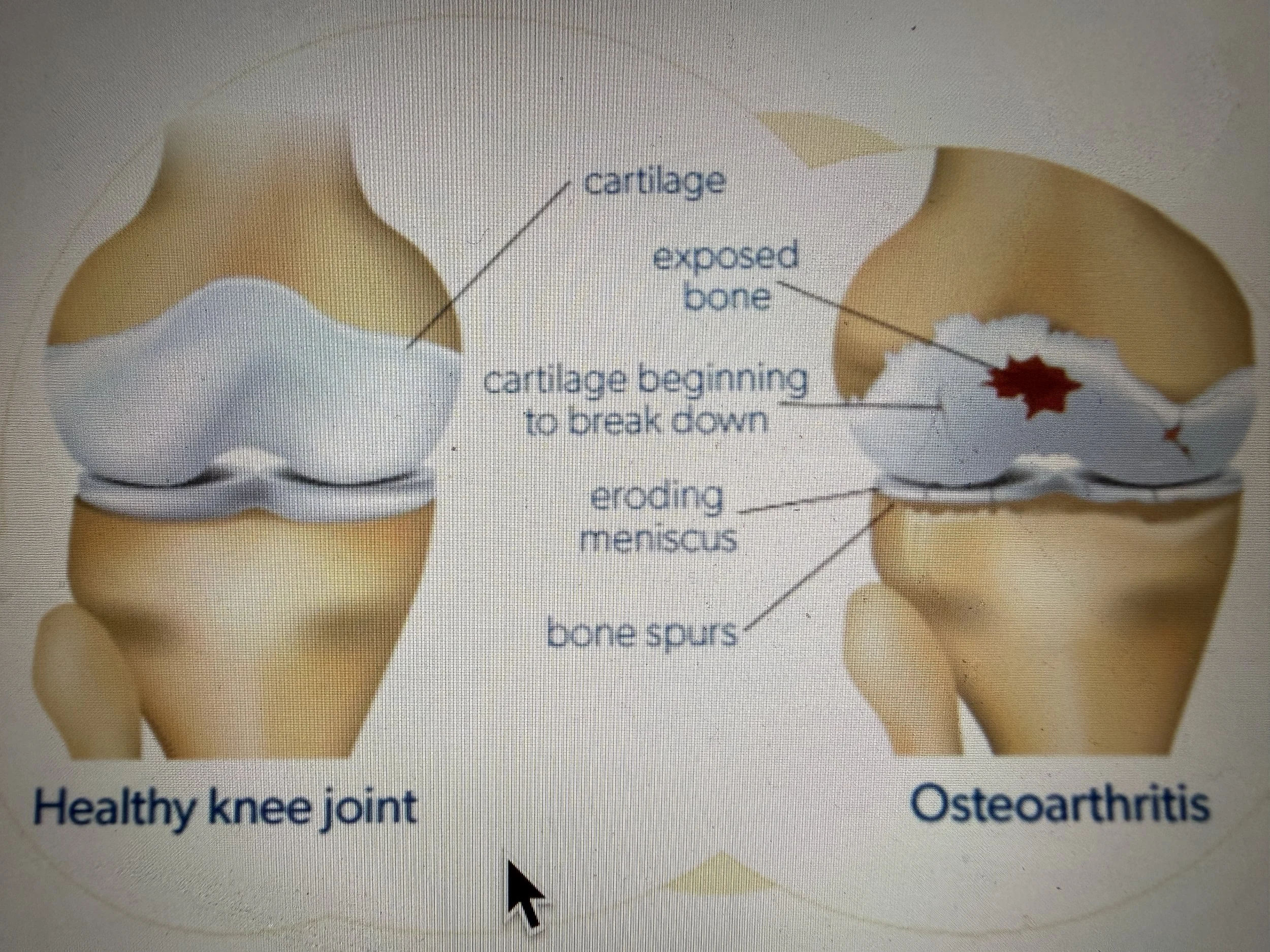 Osteoarthritis