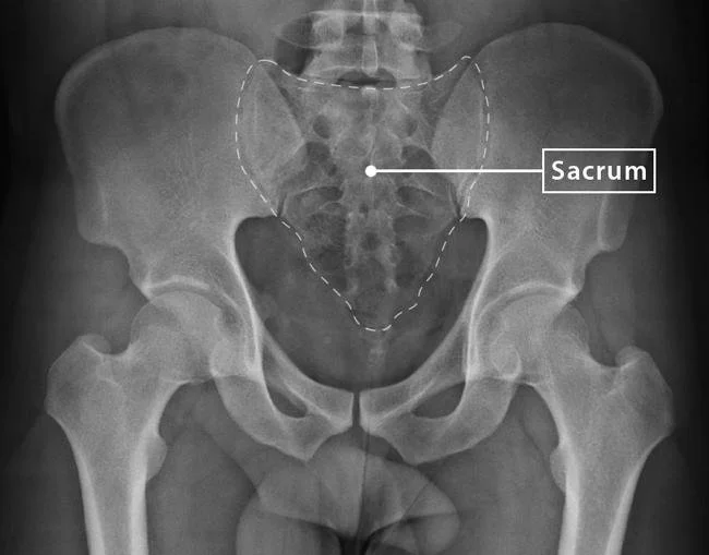 Is Your Sacrum Calling for Attention?