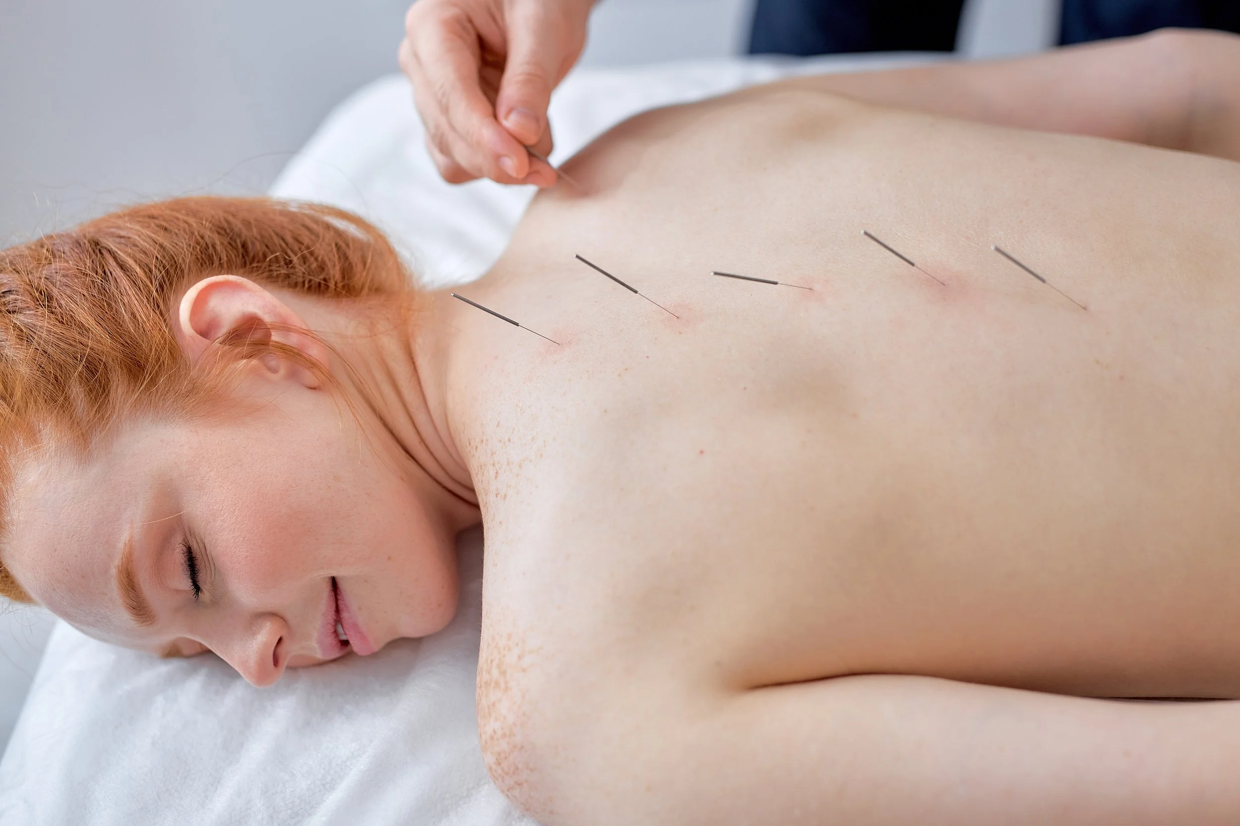 At Rolfing and Body Therapies in Los Angeles, we offer integrative, collaborative acupuncture care designed to support pain relief, nervous system balance, hormonal health, and injury recovery.