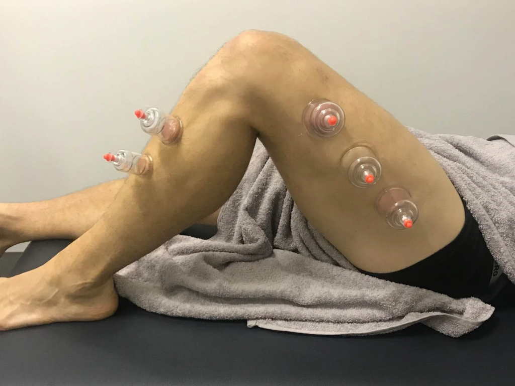 Myofascial Cupping for Lateral Foot Pain | How Decompression Restores ...