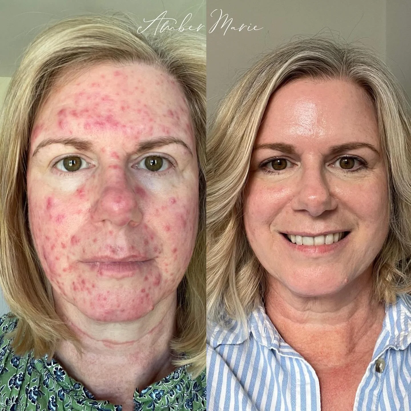 This is why I love what I do β¨
When this beautiful soul first came to me, she wasn’t just struggling with her skin – she was carrying the weight of how it made her feel every single day. Hiding behind makeup, avoiding mirrors, feeling li