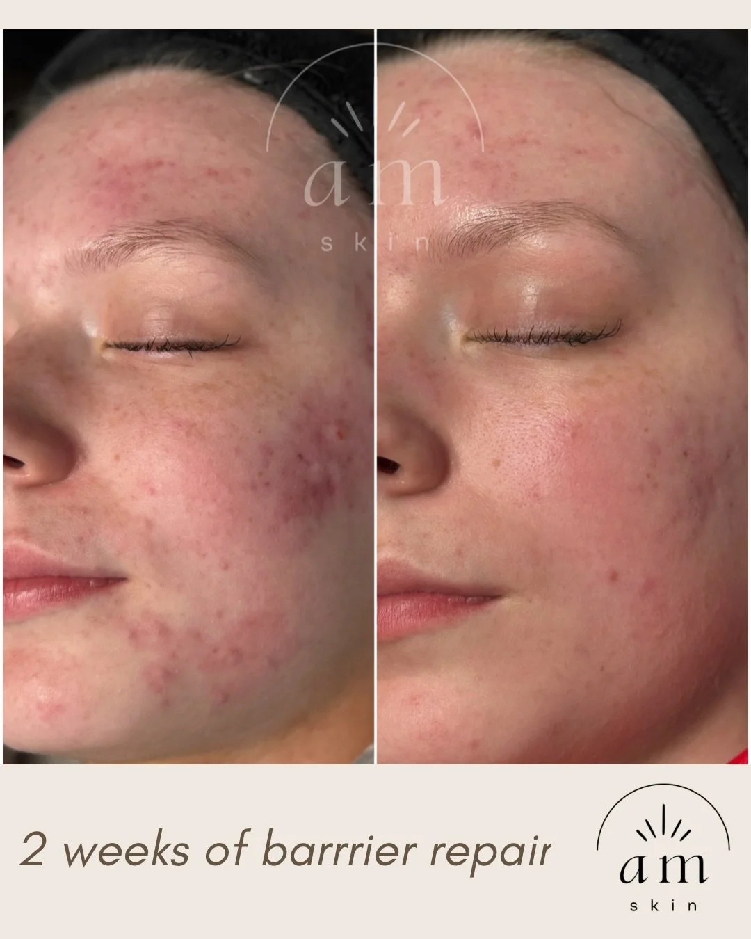 Look at what just 2 weeks of the right skincare can do 🪄✨

These results are from her customized skincare routine, which includes products that support the skin barrier as well as products that tackle breakouts @facerealityskincare

Her skin looks s