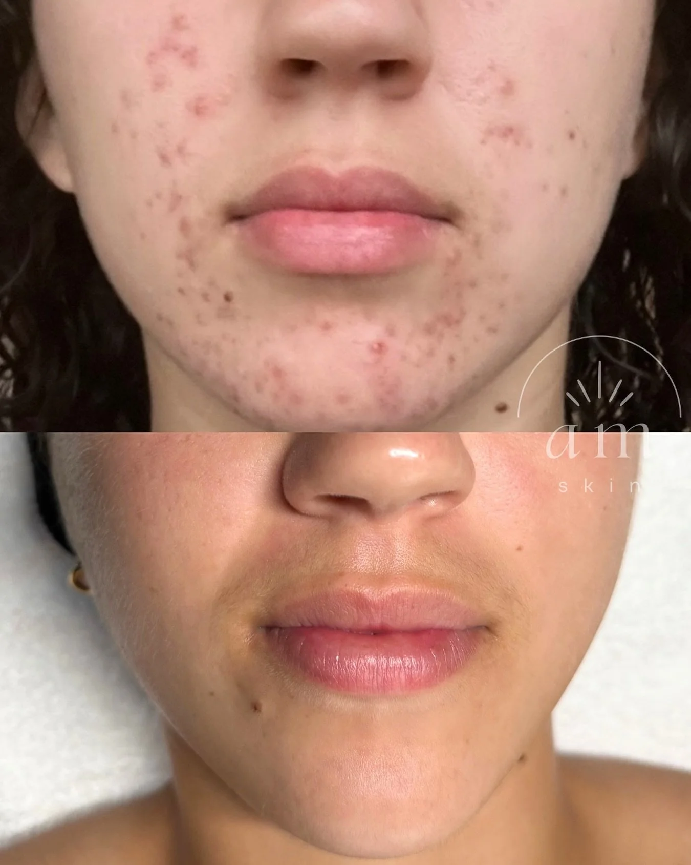 When the right skincare routine kicks in and the magic happens 🪄✨
&bull;
&bull;
#acne #acneskincare #acnetips #glowingskin #corvallis #skincare