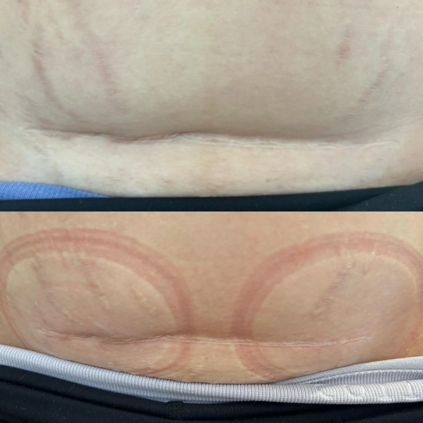 This beautiful mumma came to me after 2 C-sections.
She was experiencing pain, numbness, bumps along her scar and a body that no longer felt like hers. 

These were her results after just 2 treatments. 

You can see the physical changes, but what you